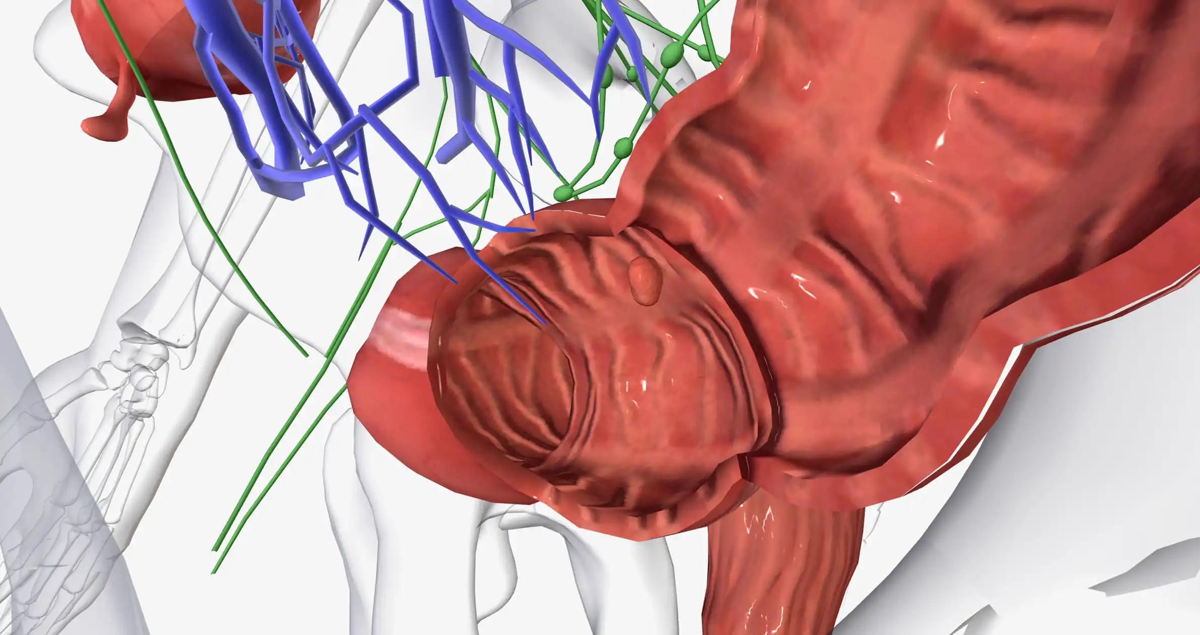 Colorectal Cancer CRC Common Colon