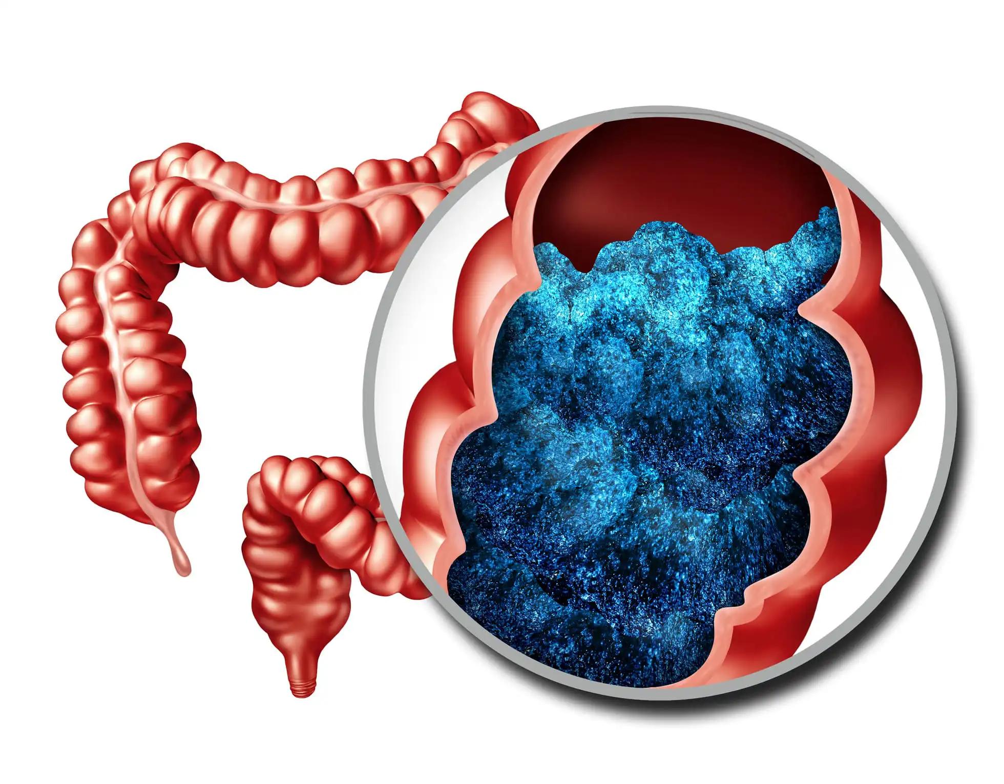 Constipation Anatomy and Constipation Symptoms