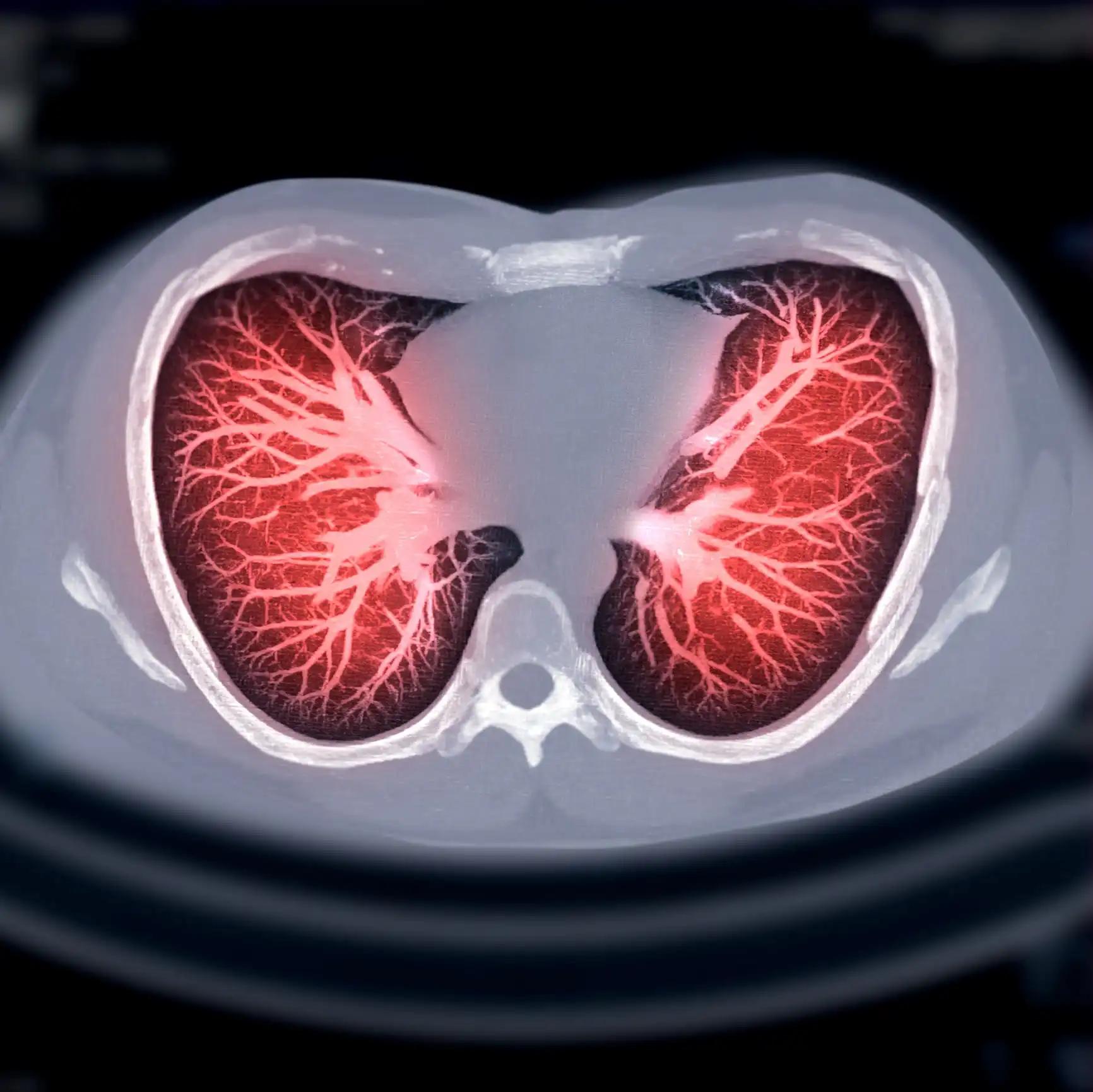 CT Chest AXIAL MIP View for Diagnostic Lung Cancer