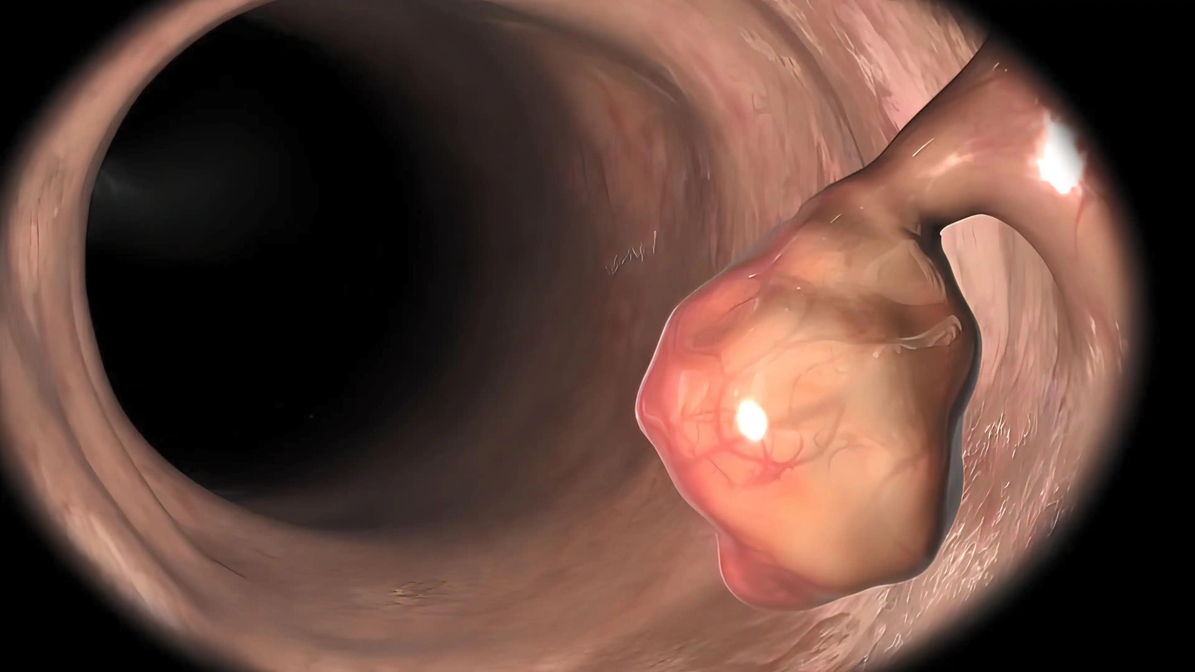 Esophageal Cancer Colorectal Polyps