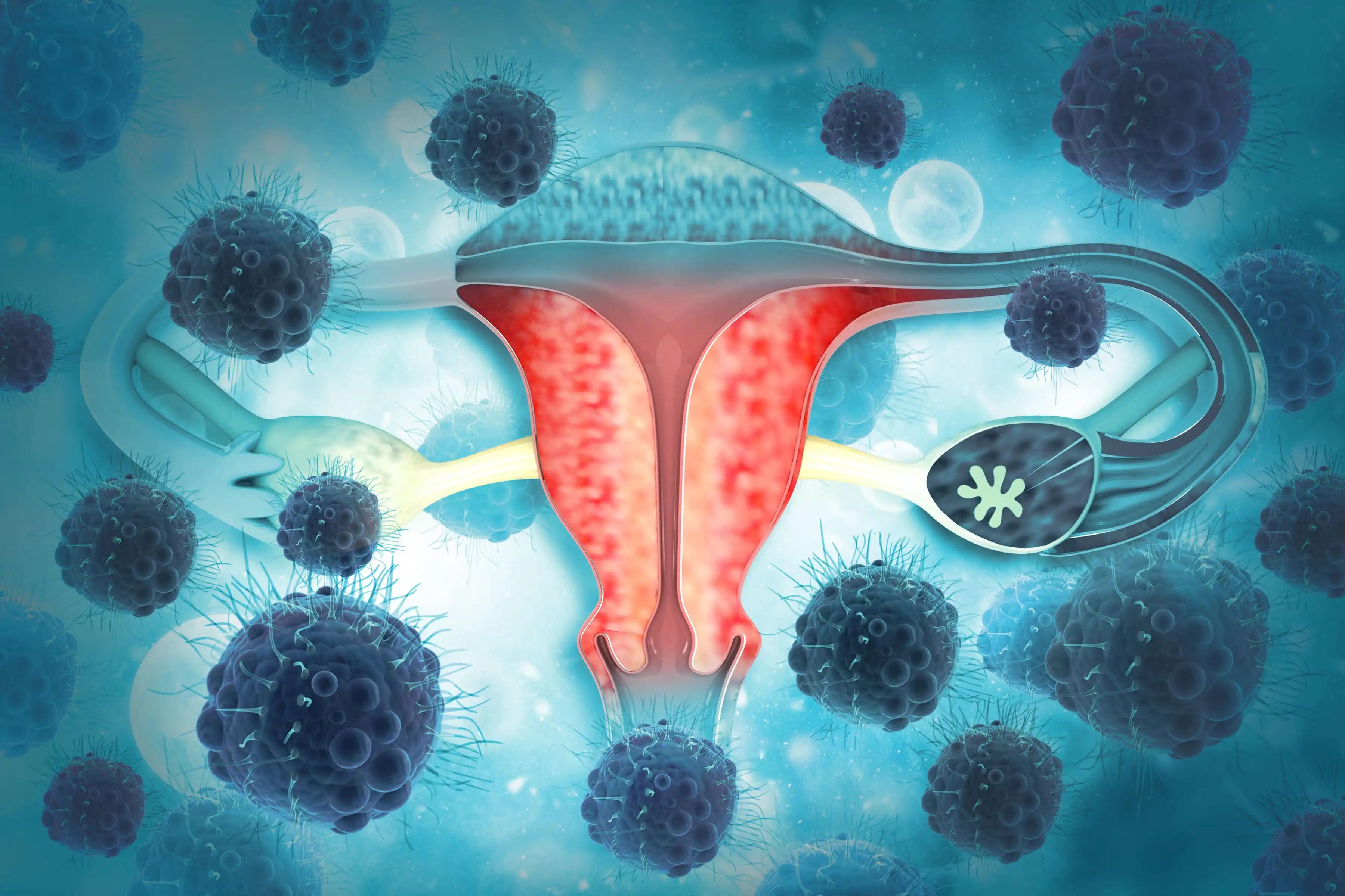 Gynecologic Oncology Cancer