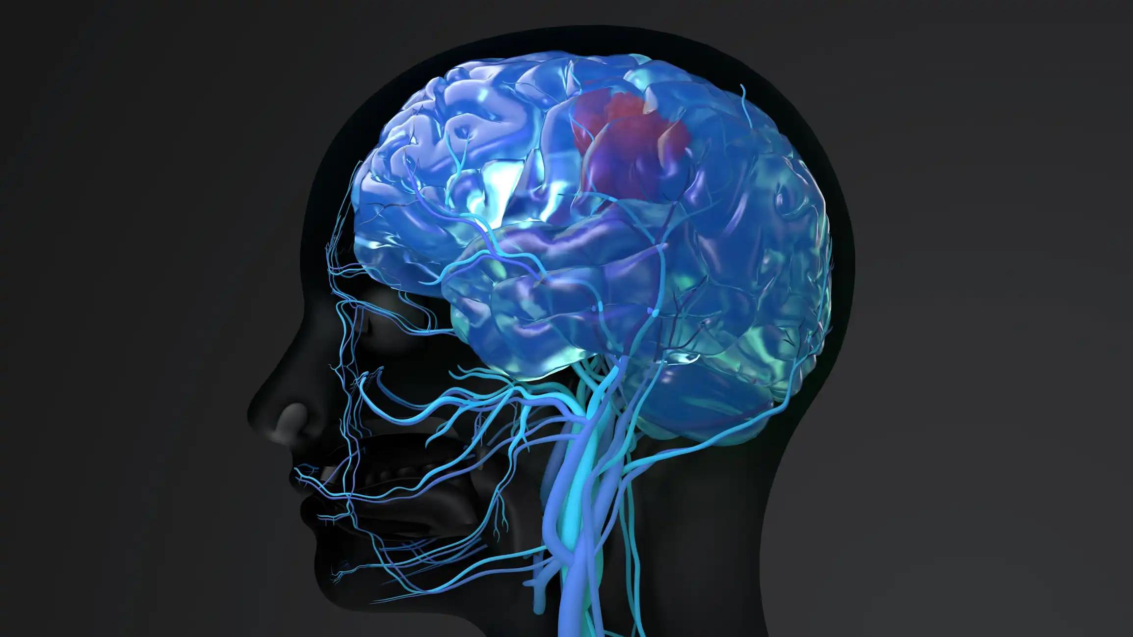 Head with Tumor Inside Brain with Blood Vessels