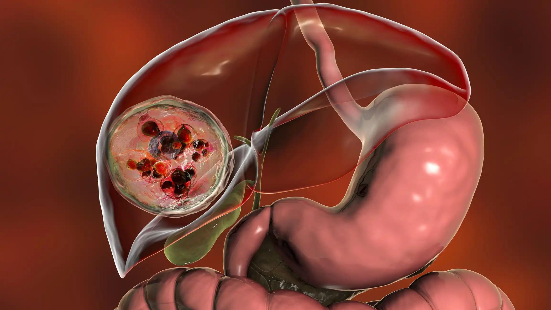 Hydatid Cyst Caused by Echinococcus Granulosus in the Liver