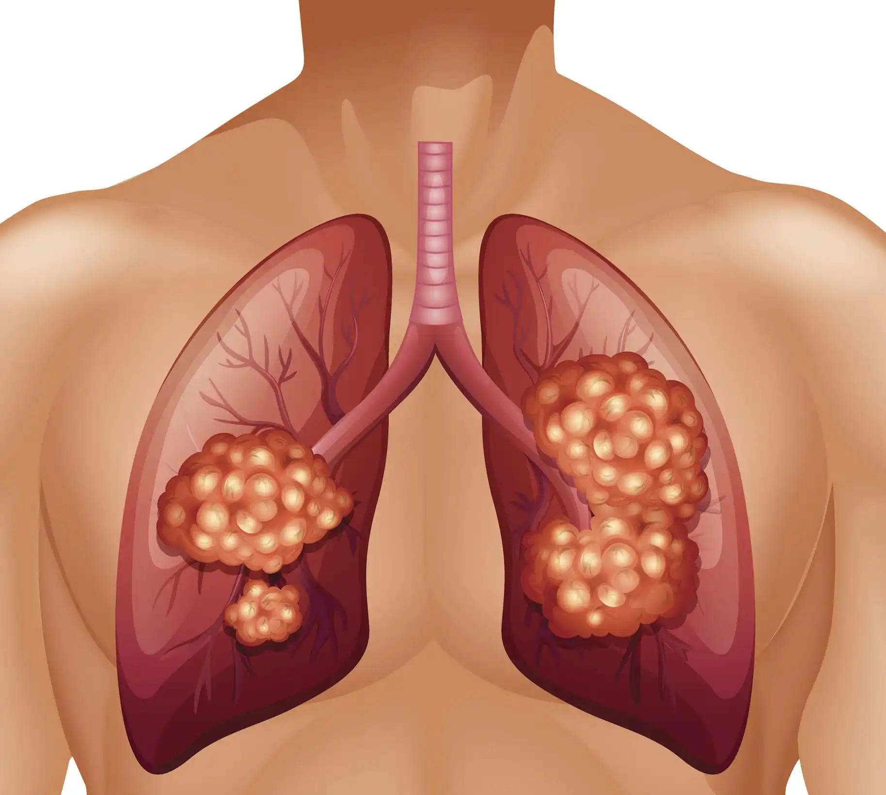 Illustration of Lung Cancer