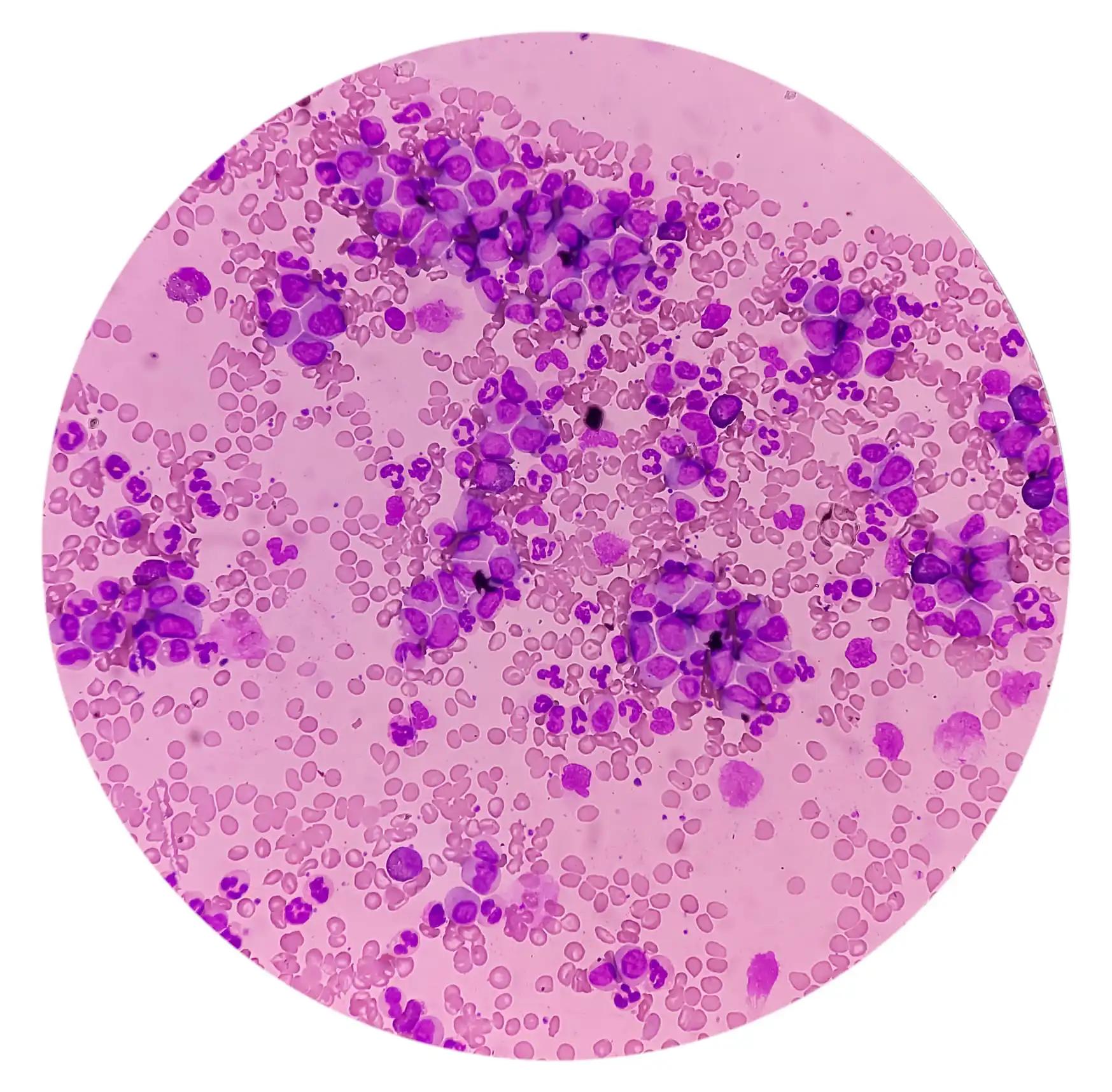 Lymphocytosis with Thrombocytopenia show White Blood Cells and Red Blood Cells