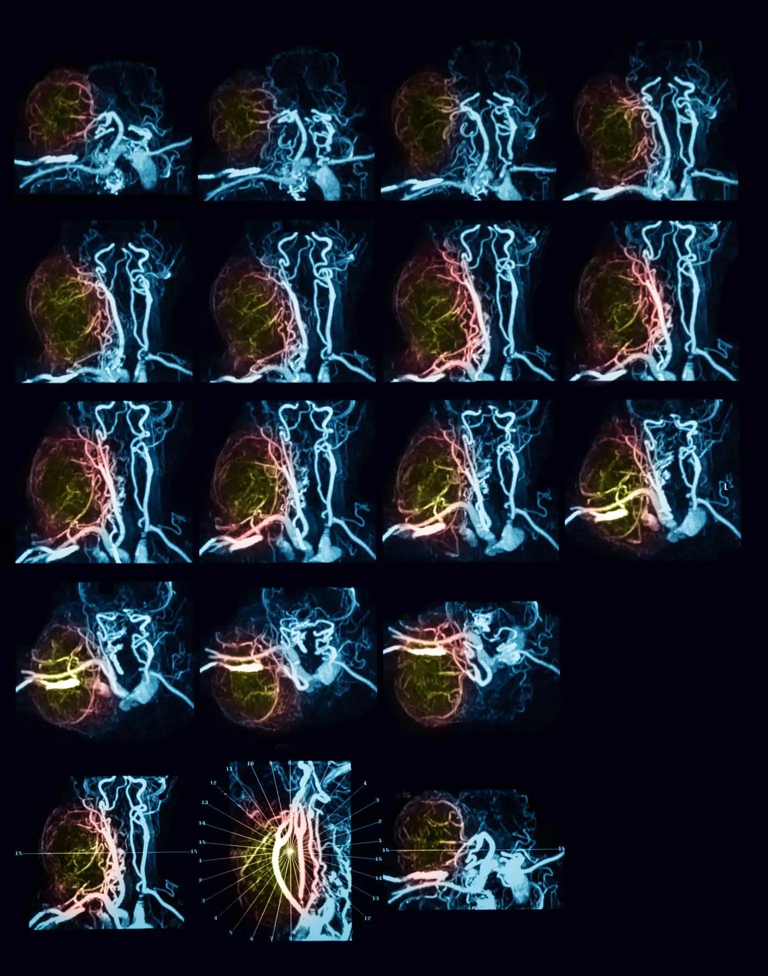 Magnetic Resonance Angiography of Neck Cancer