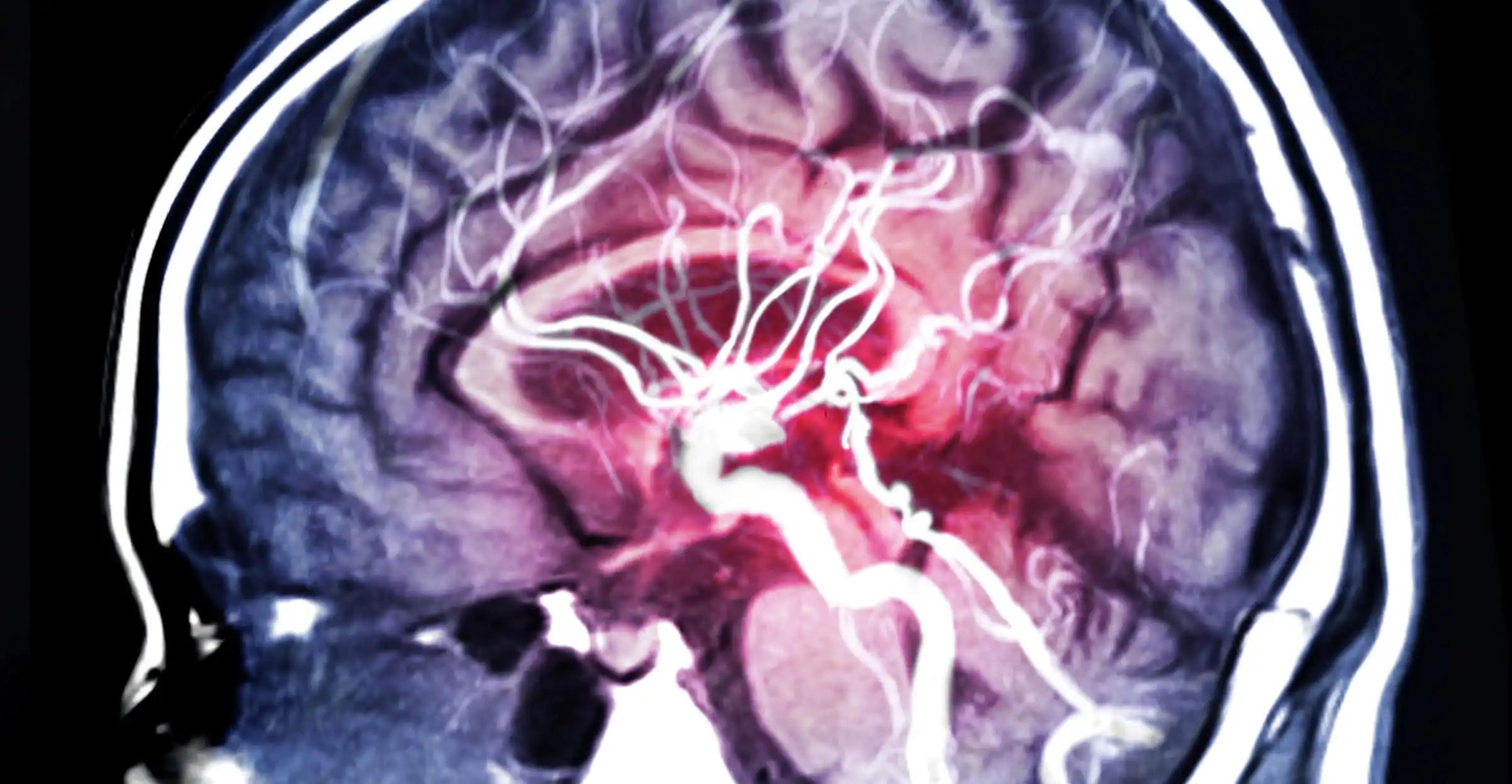 Magnetic Resonance Angiography of Vessel in Brain