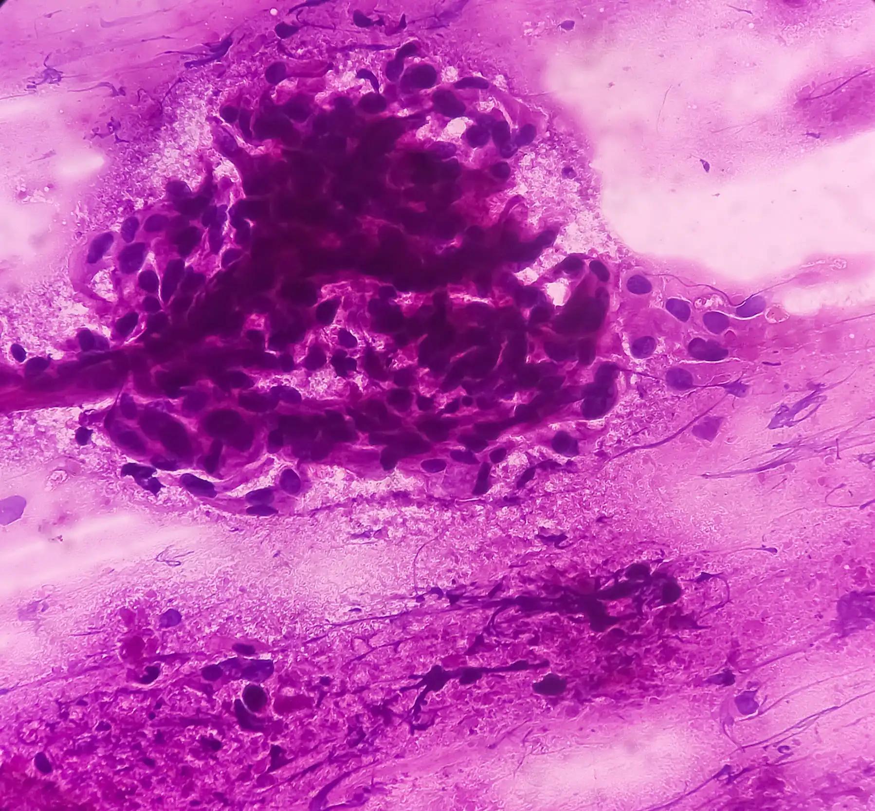 Malignant Cells Bronchoalveolar Adenocarcinoma