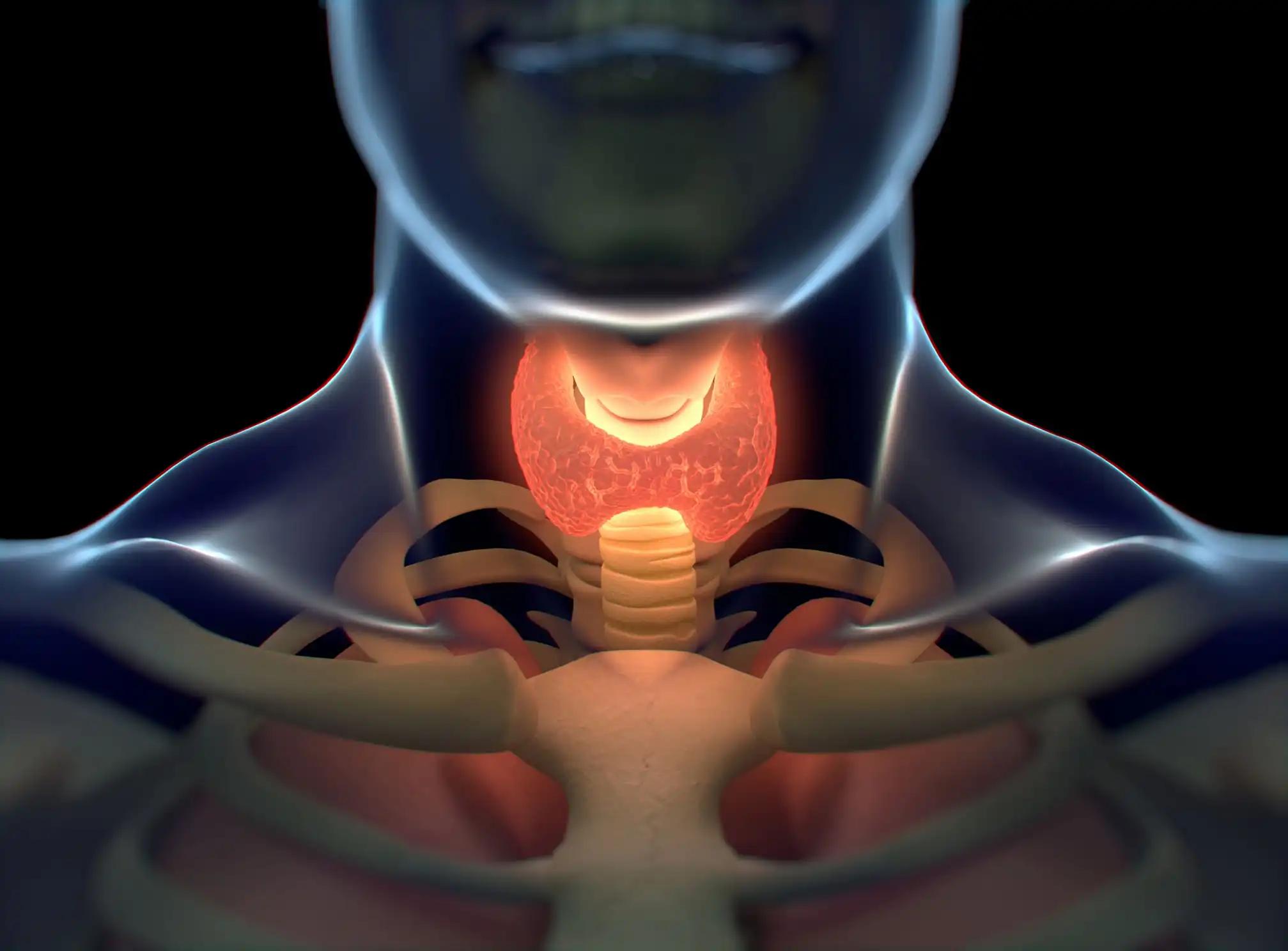 Medullary Thyroid Cancer