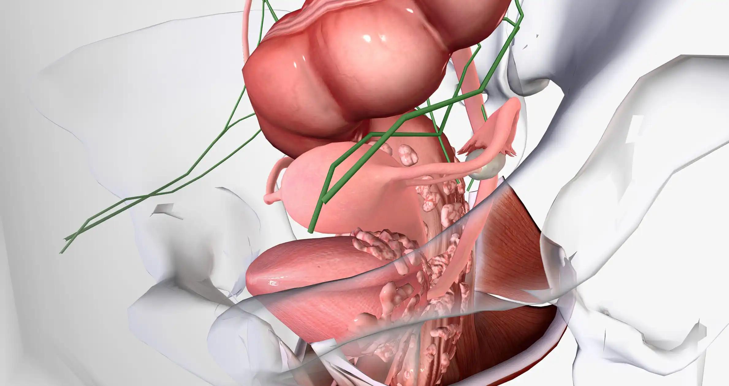 Metastatic Urothelial Patients Cancer Platinum Therapy