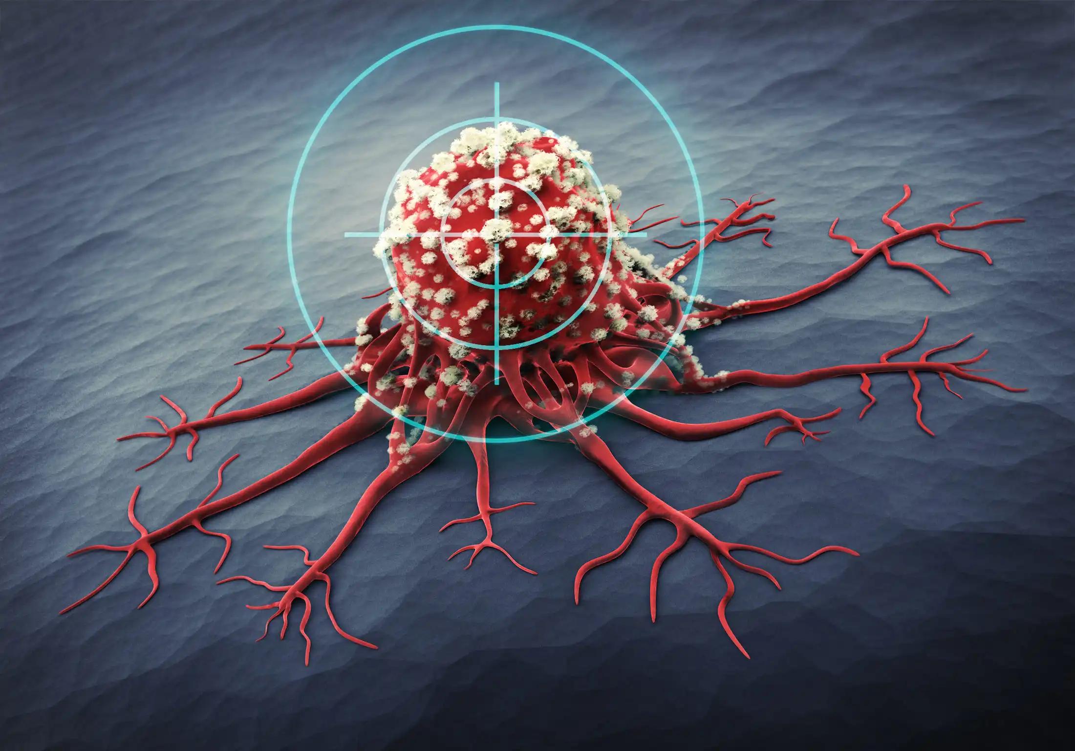 Metastatic Uveal Melanoma Tumor 3D