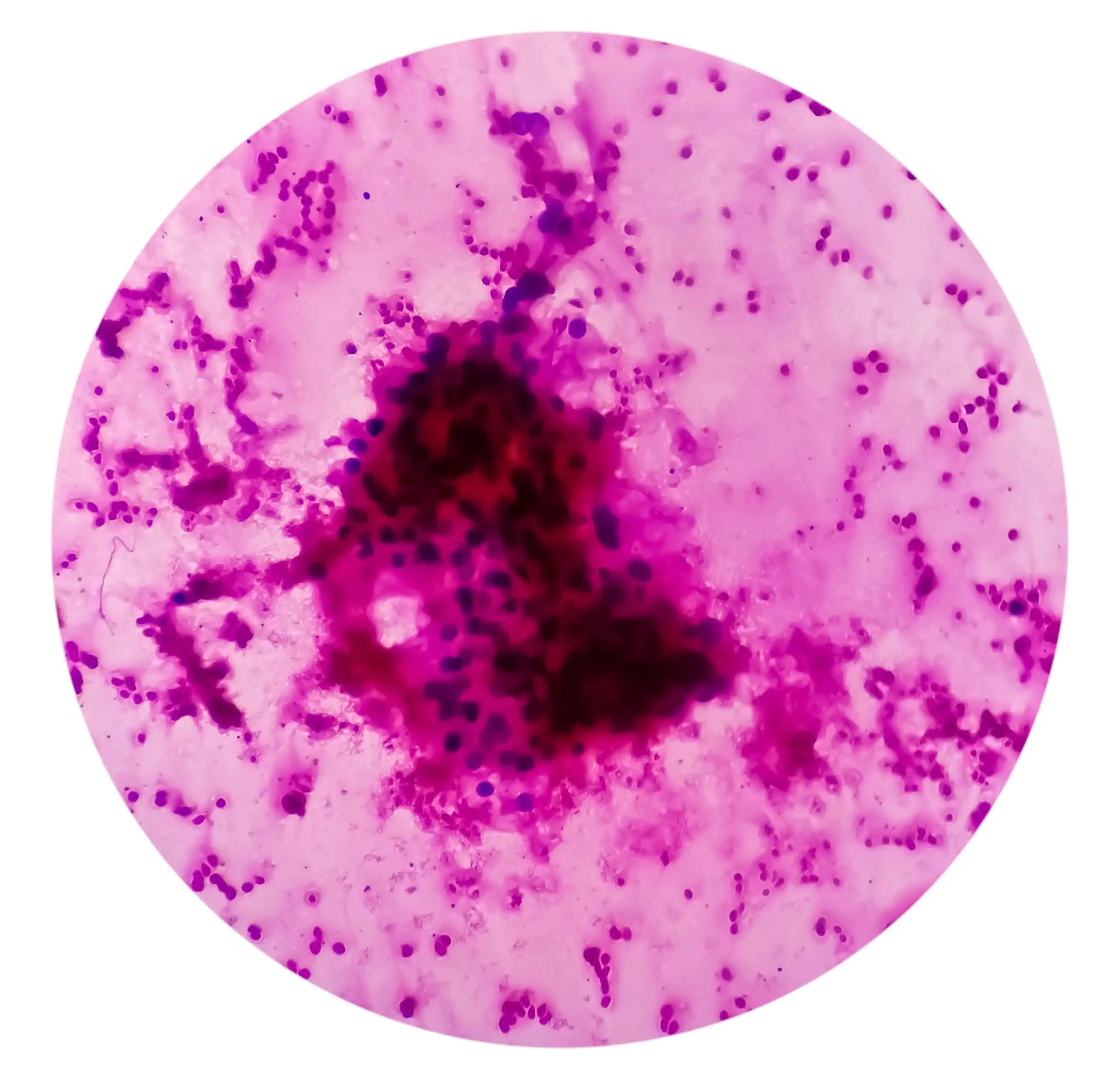 Microscopic View of Renal Cell Carcinoma 