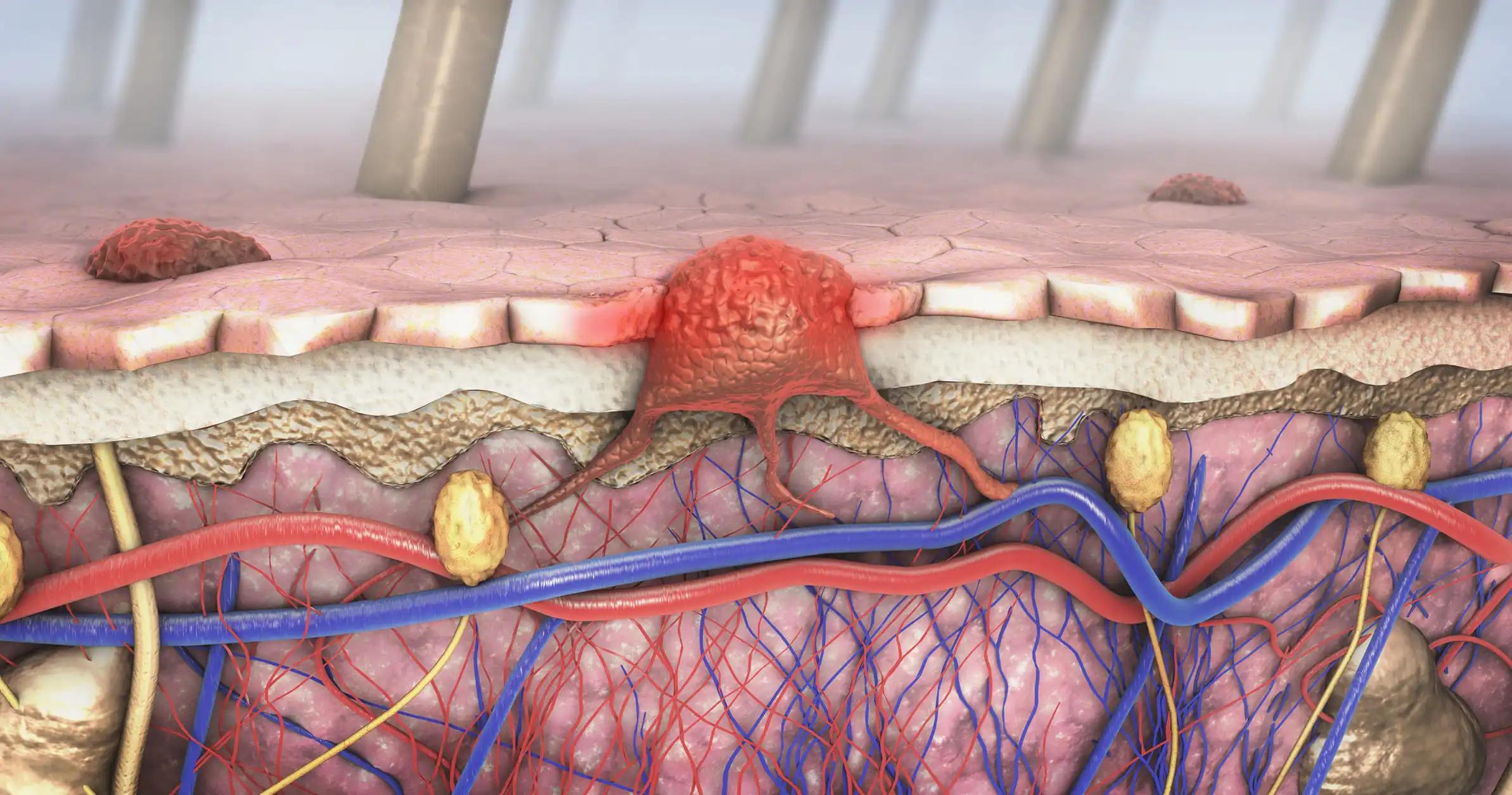 Molecular Treatment of Melanoma