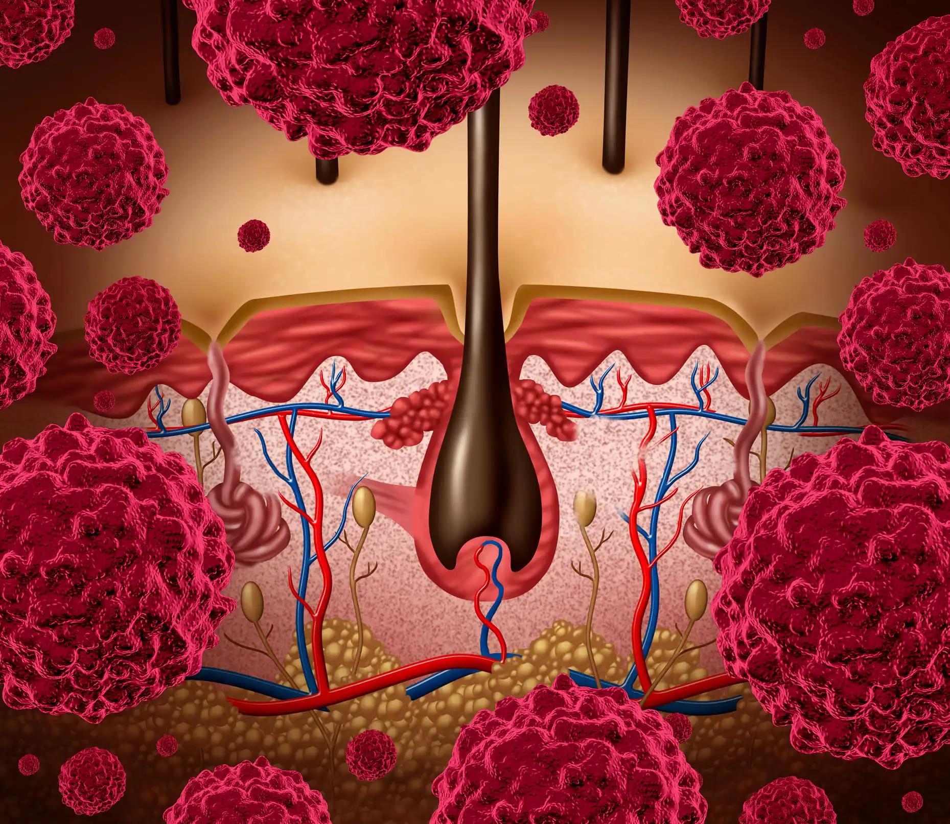 Nivolumab Combination Therapy For Melanoma