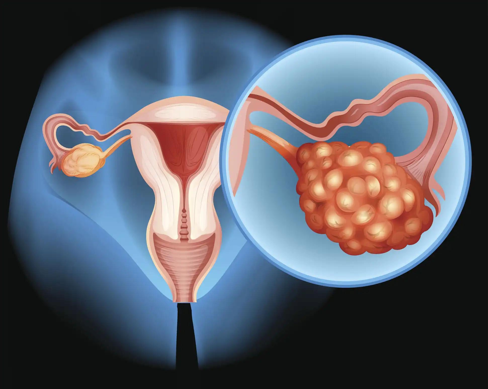 Ovarian Abnormal Cancer Cells Under Microscope