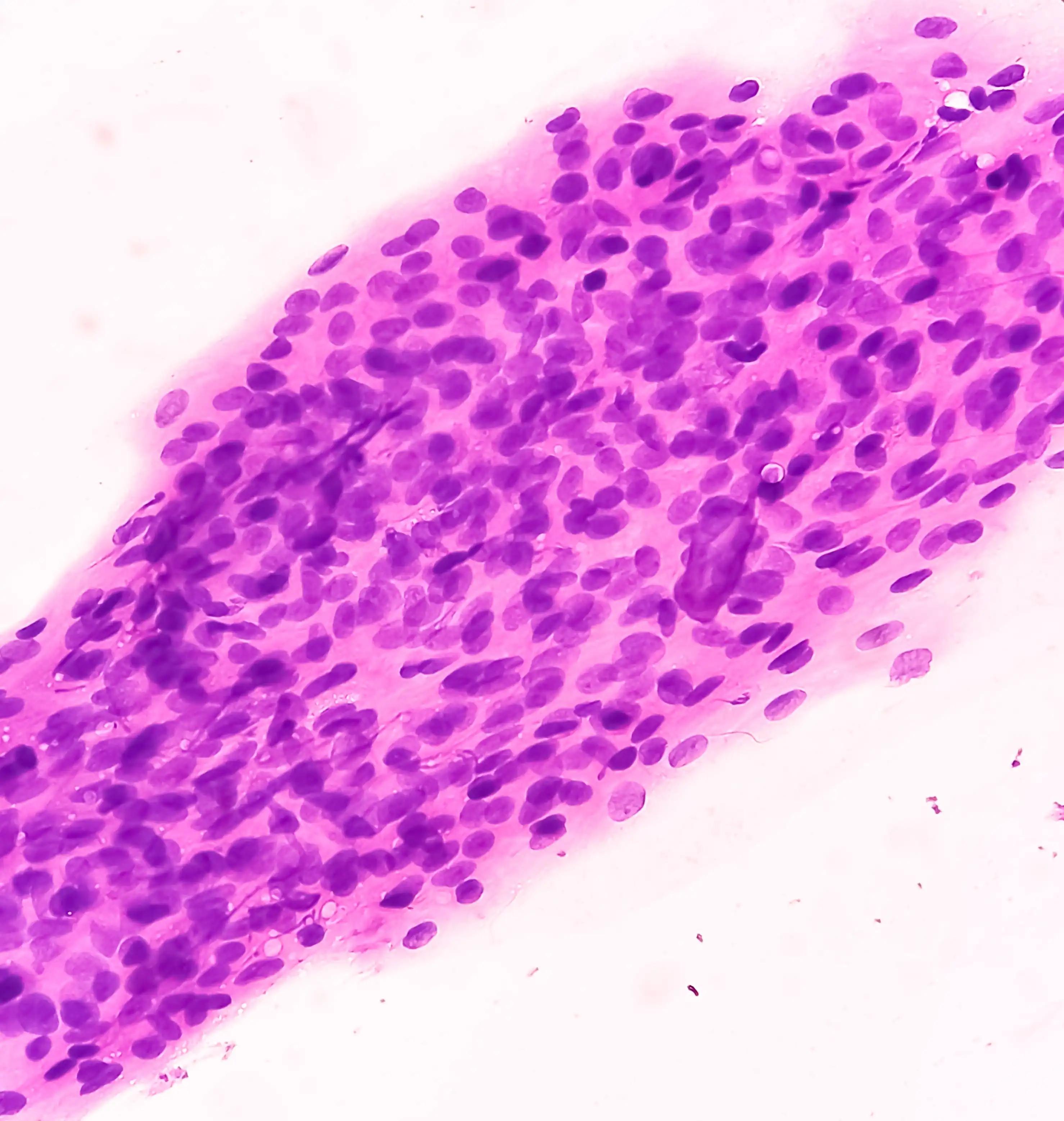 Pap smear Image Depicting Cellular Changes Consistent with HSIL