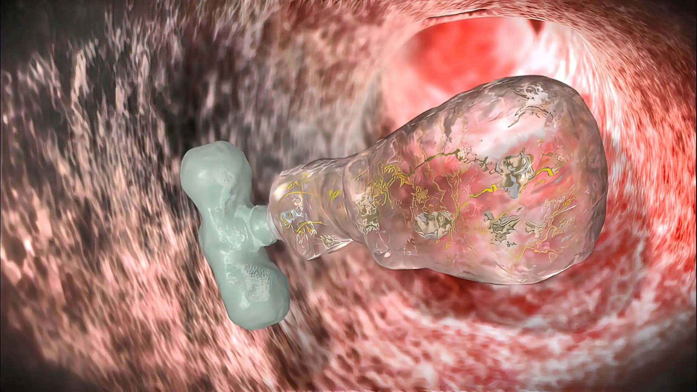 Pembrolizumab and Platinum-Based Chemotherapy