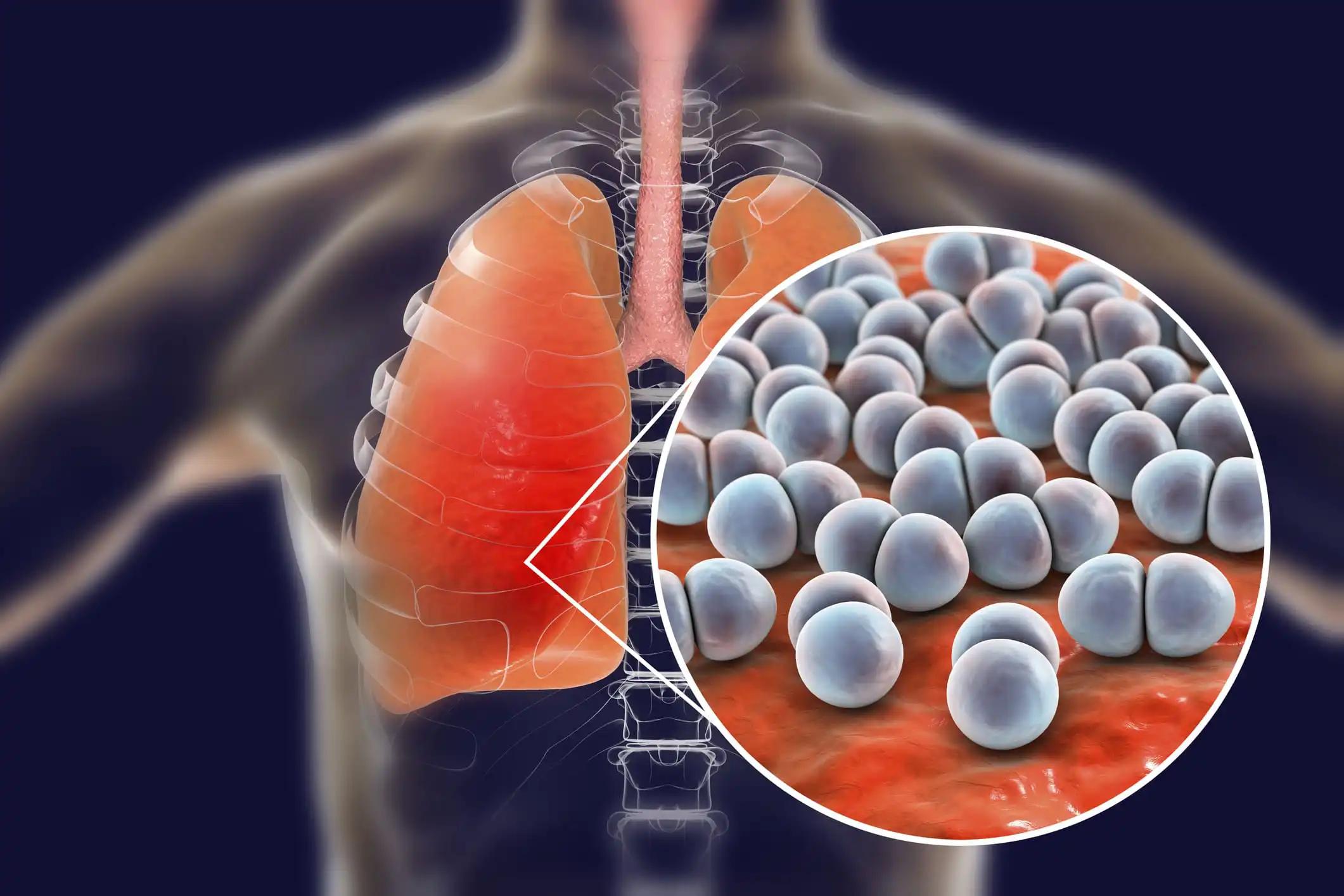 Pneumococcal Pneumonia Infection in Lungs