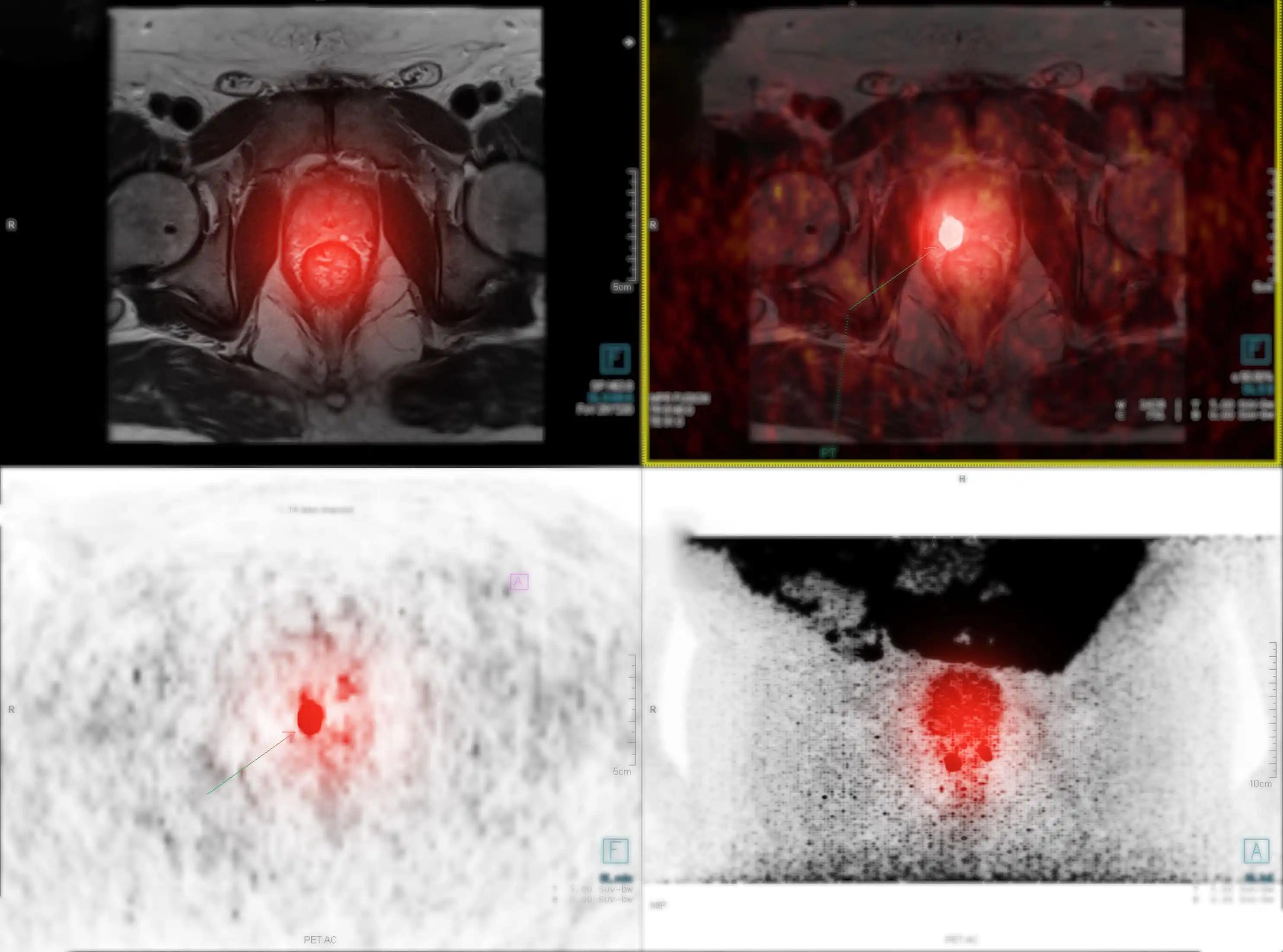 Prostate Scan