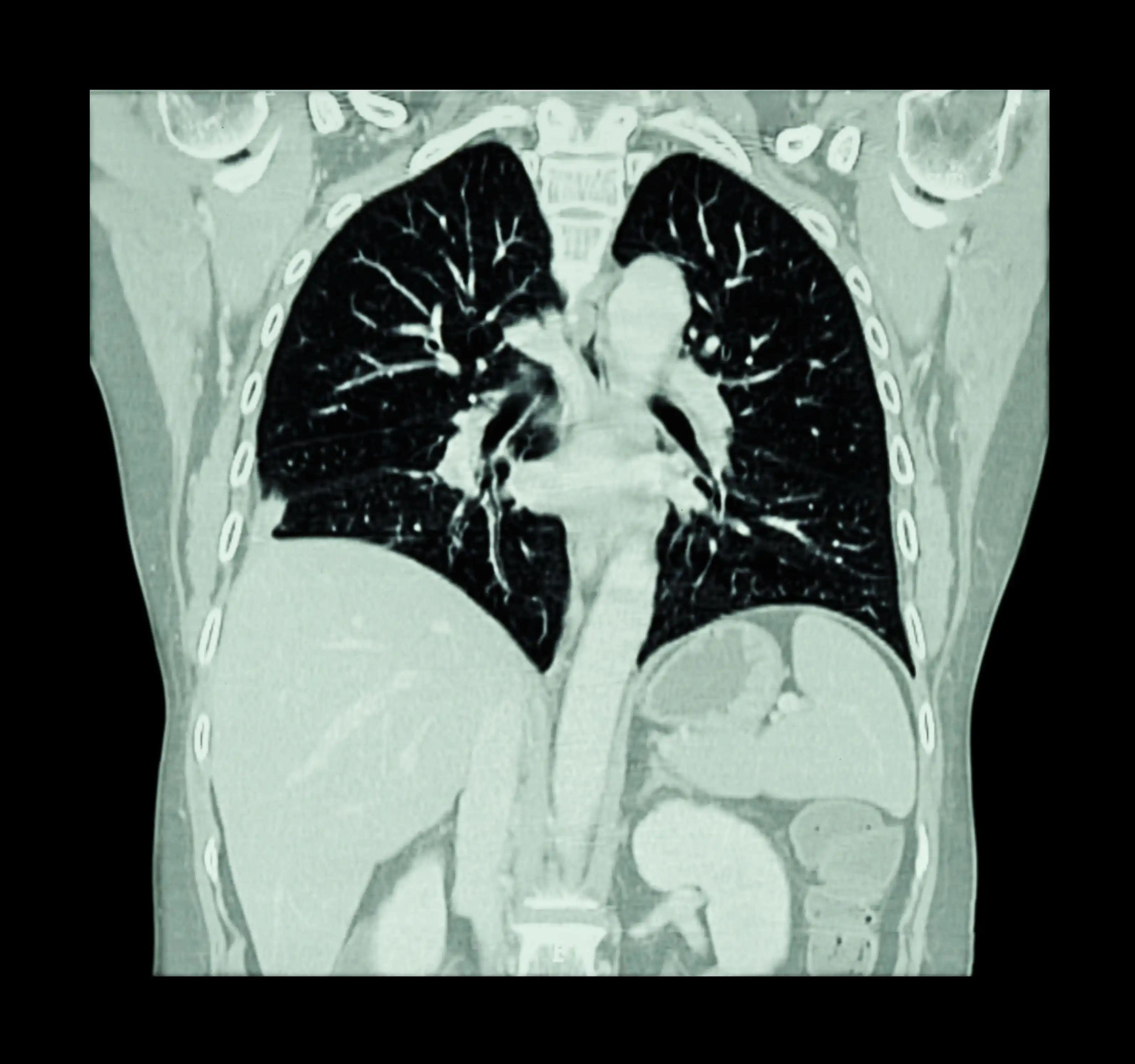 Pulmonary Embolism Diagnosis Through CT Scan