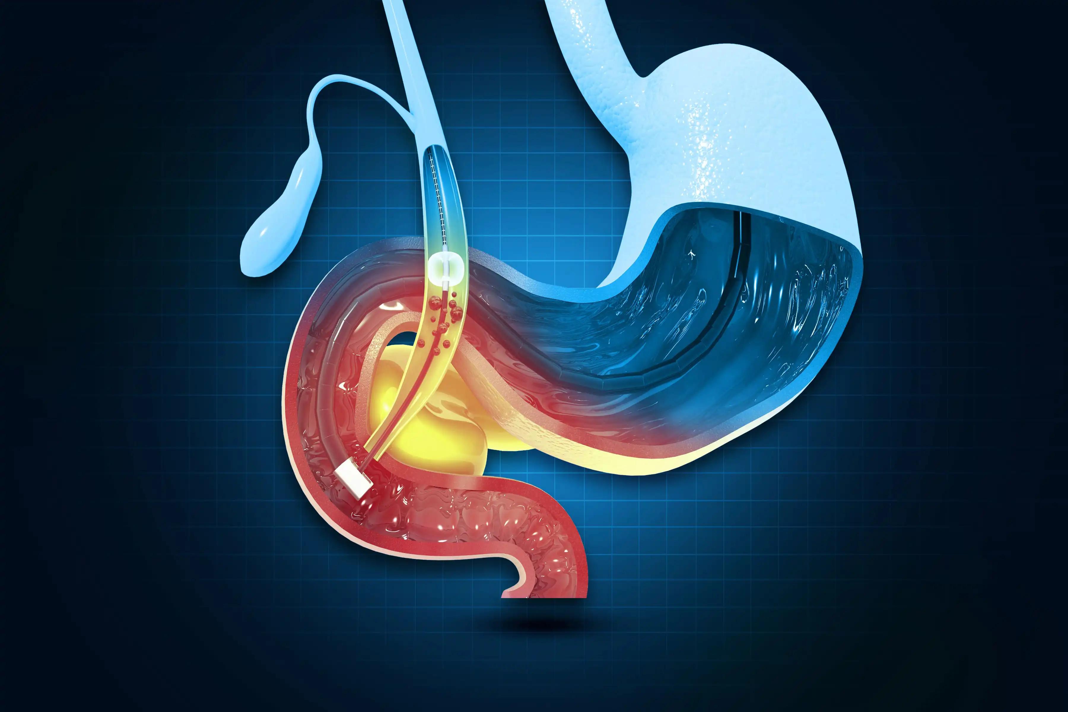 Radical Cystectomy for Gallbladder Cancer