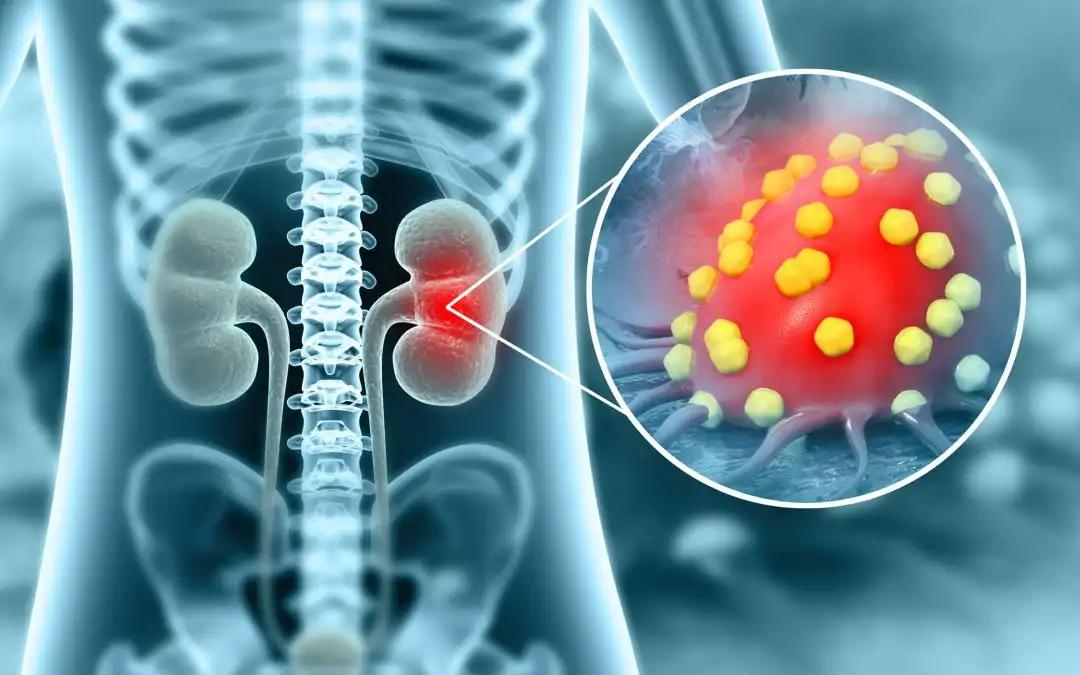 Belzutifan Shows PFS Benefits Over Everolimus in ccRCC