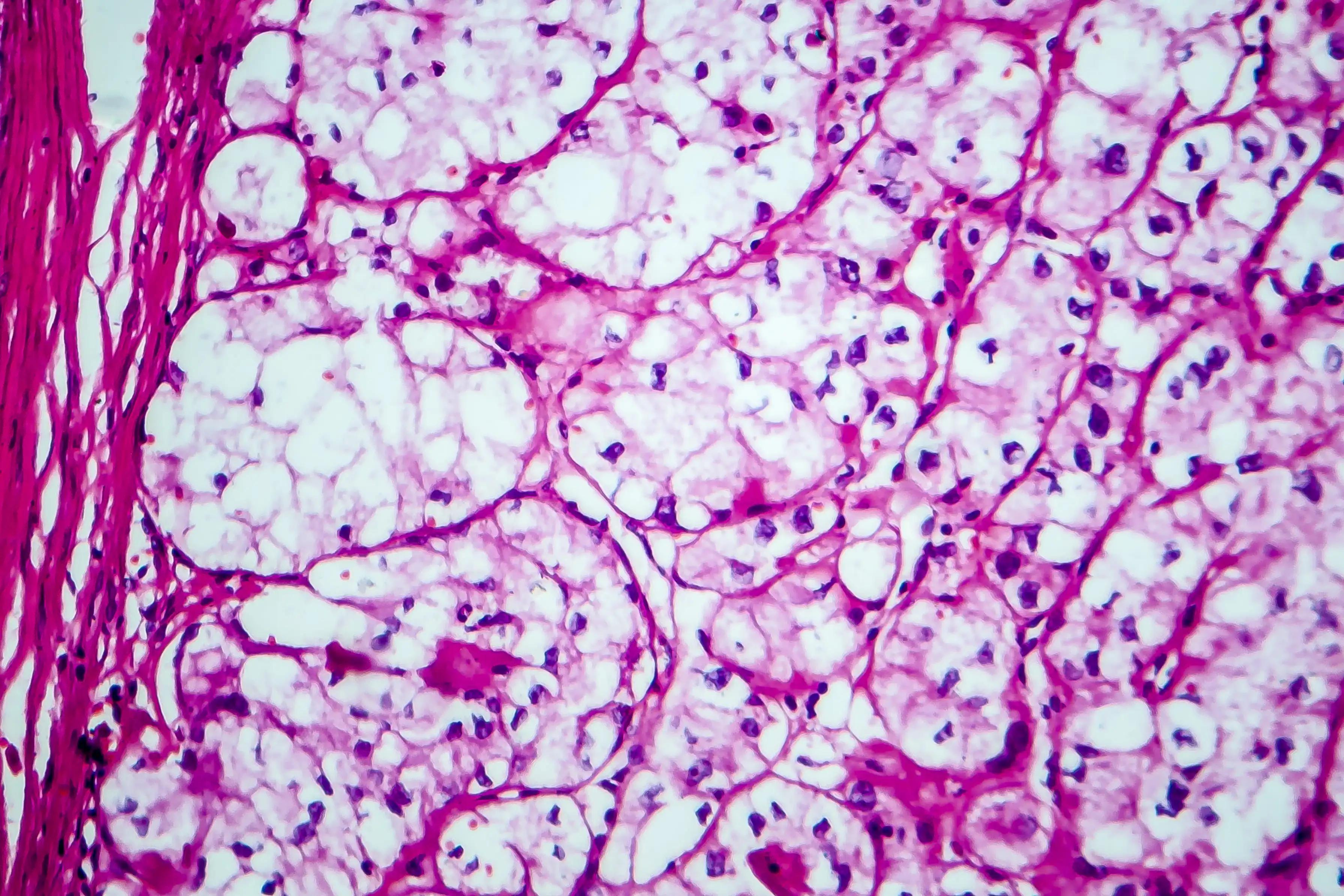 Renal Cell Carcinoma Micrograph Under Microscope