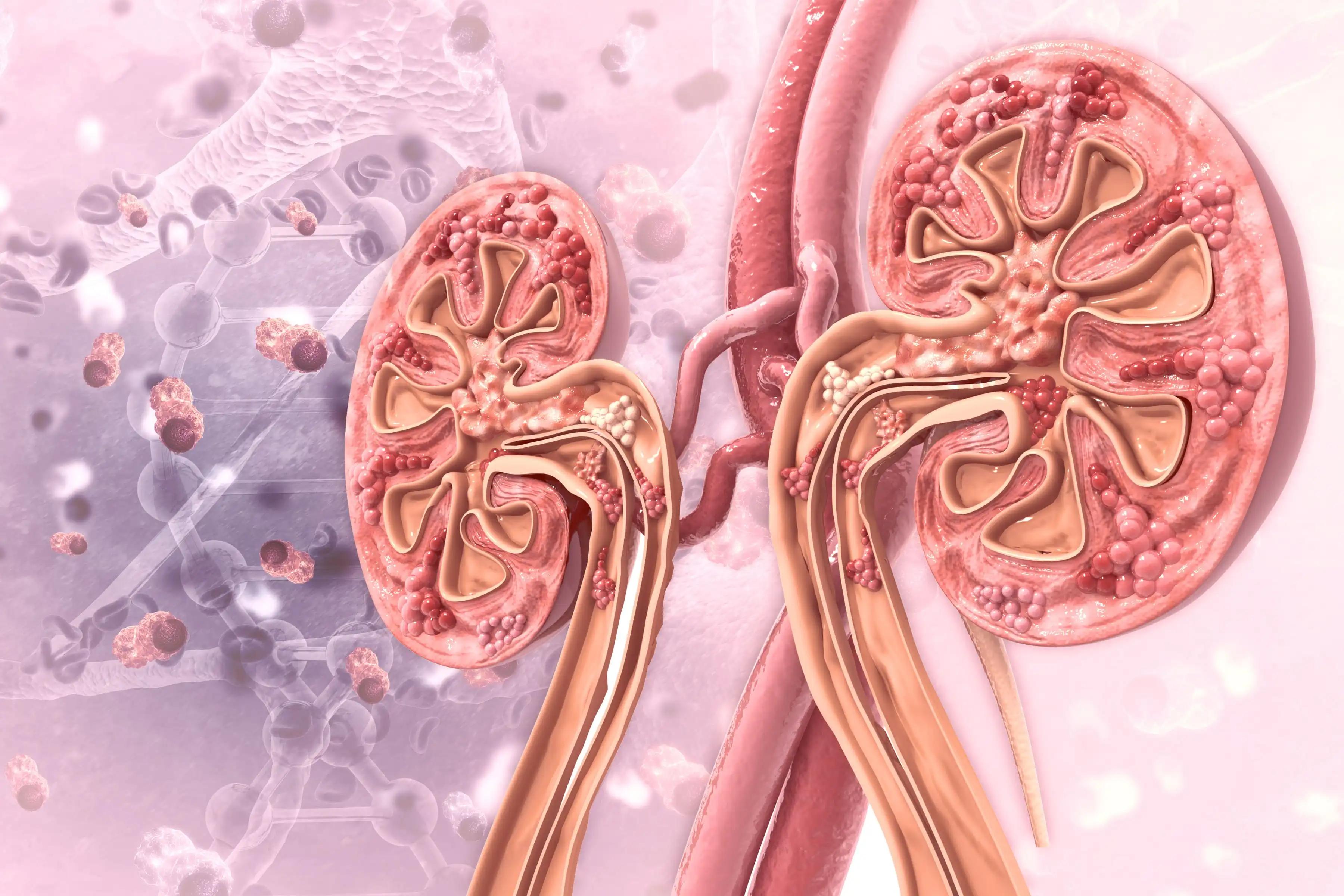 Renal Cell Carcinoma Tumor 3D