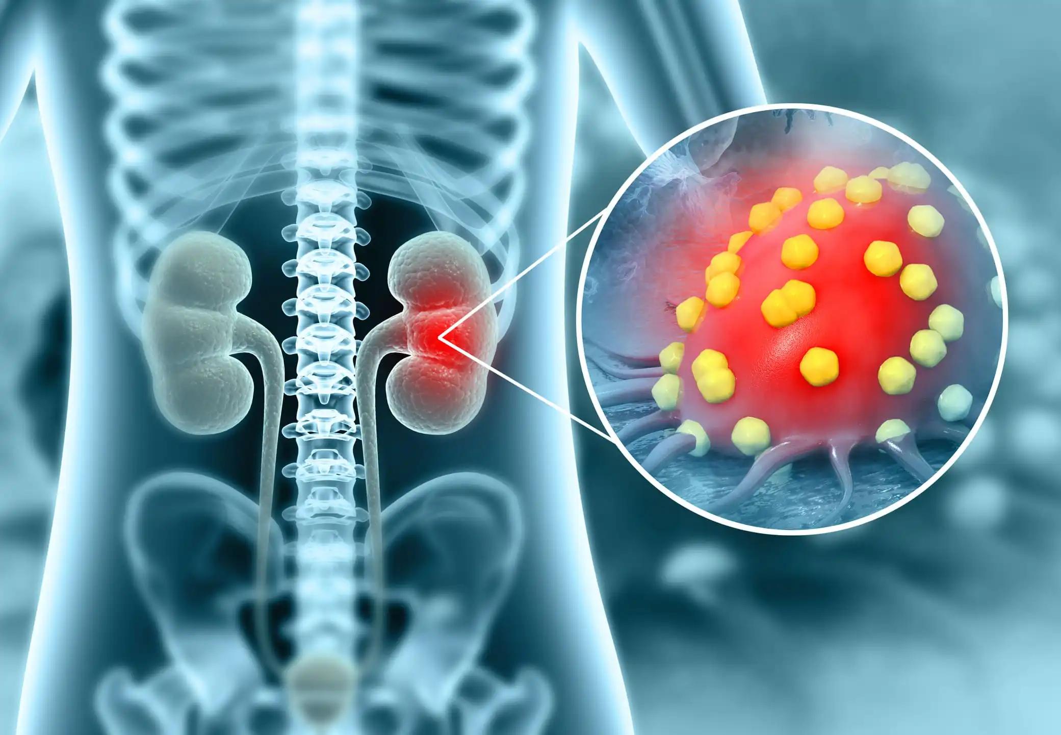 Renal Cell Carcinoma Viral Infection