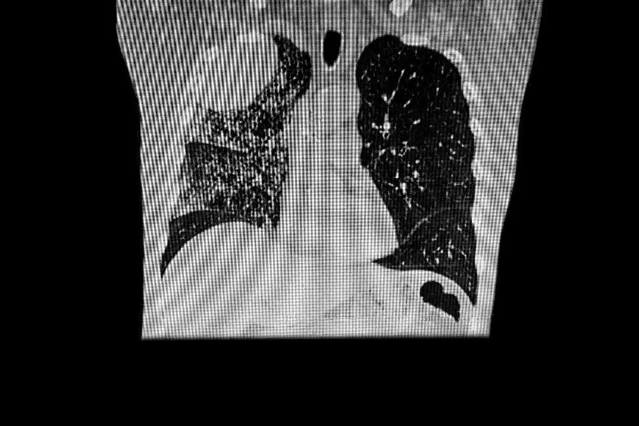 Right Hilum Lung Tumor