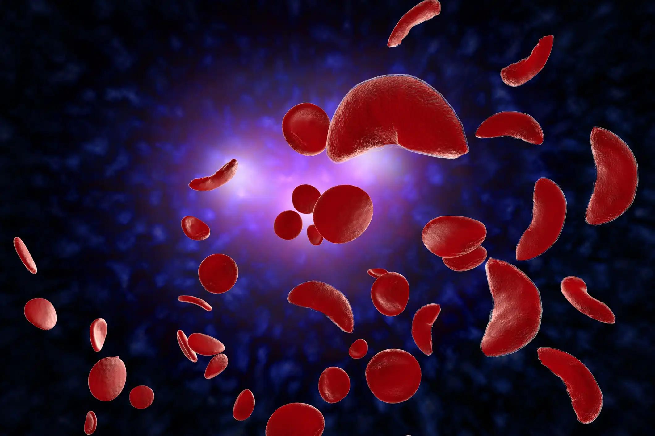 Sickle Cell Anaemia Disease