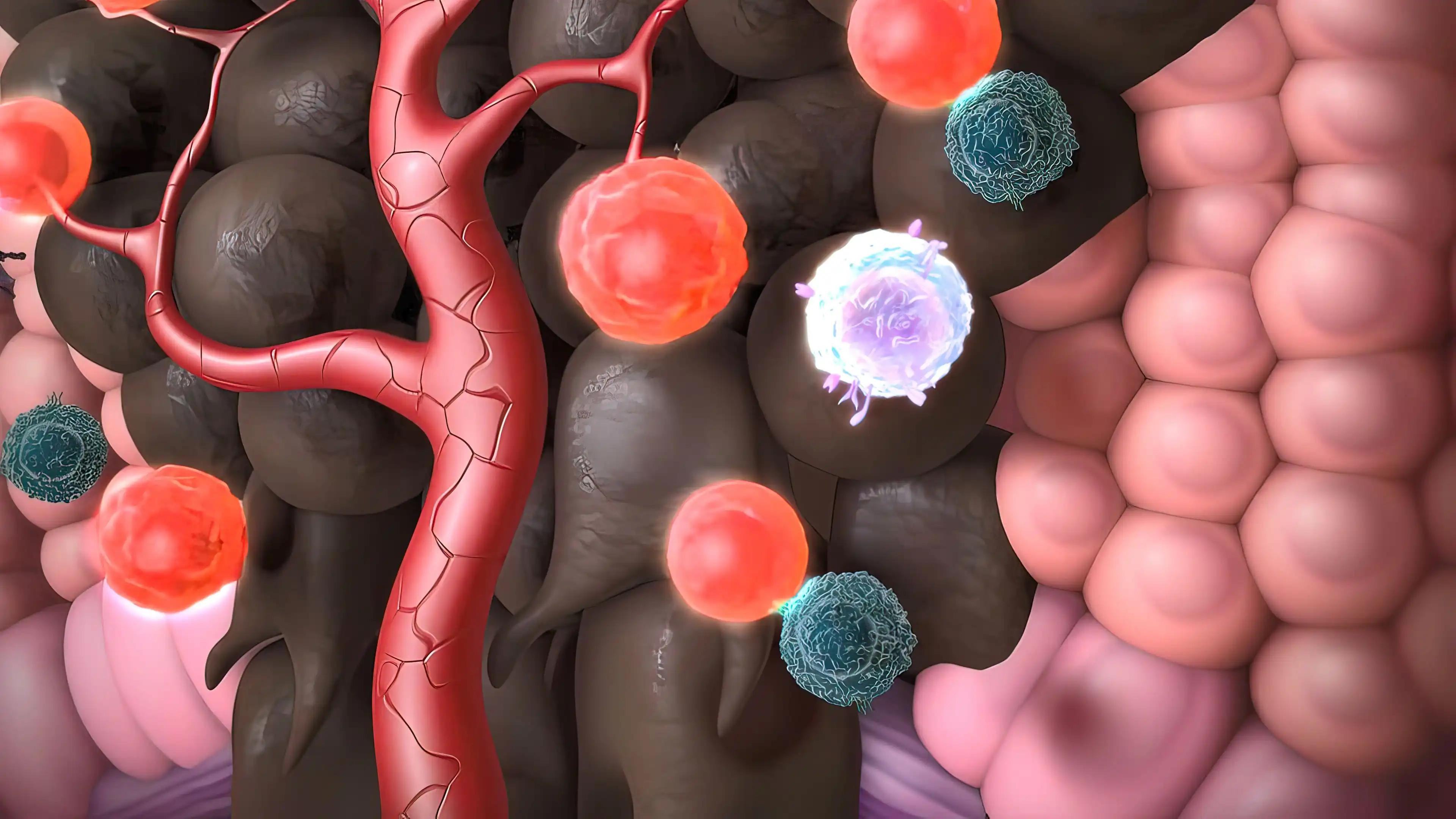 Skin Cancer: Squamous Cell Carcinoma