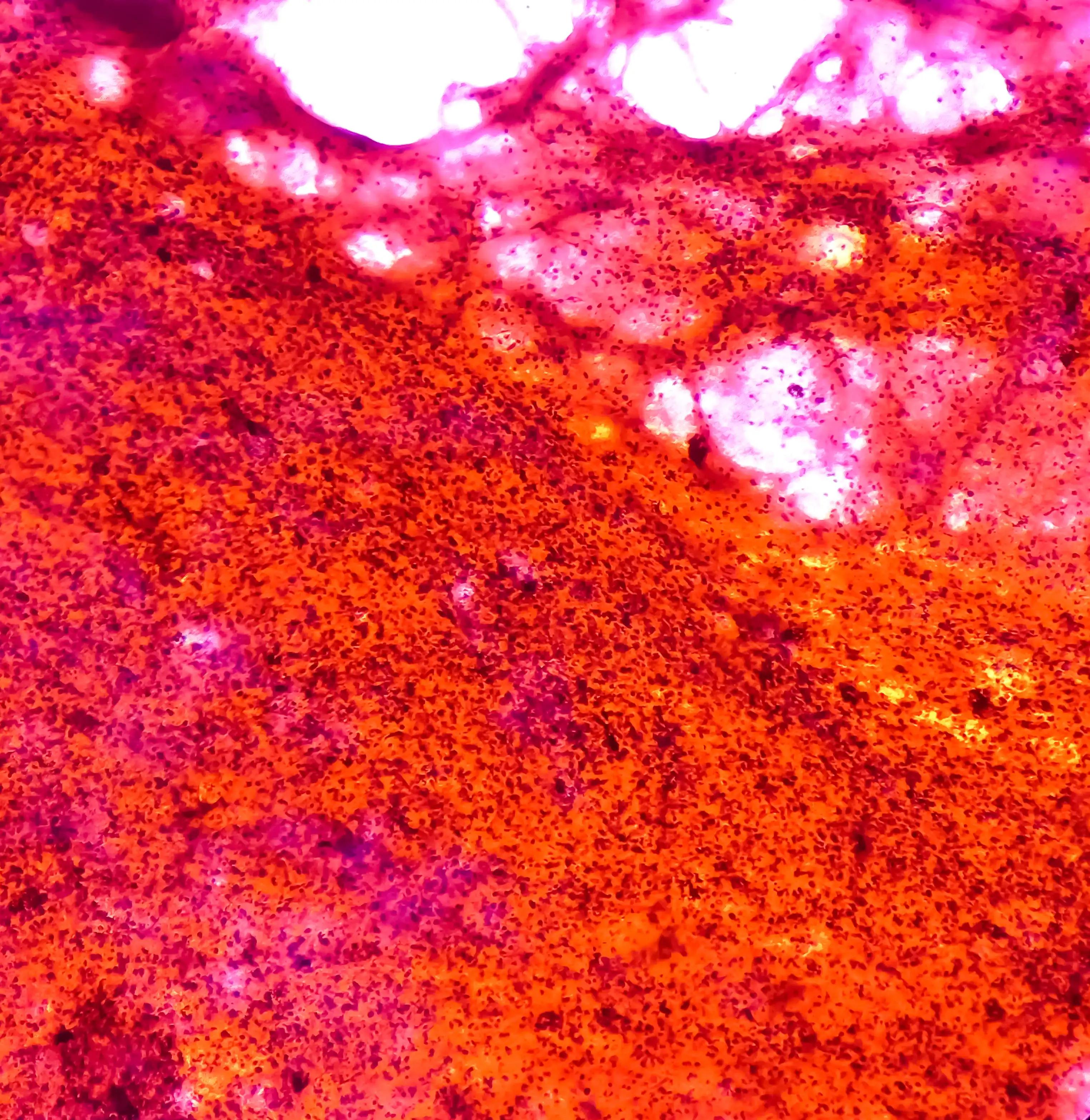 Microscope View of Small Cell Carcinoma