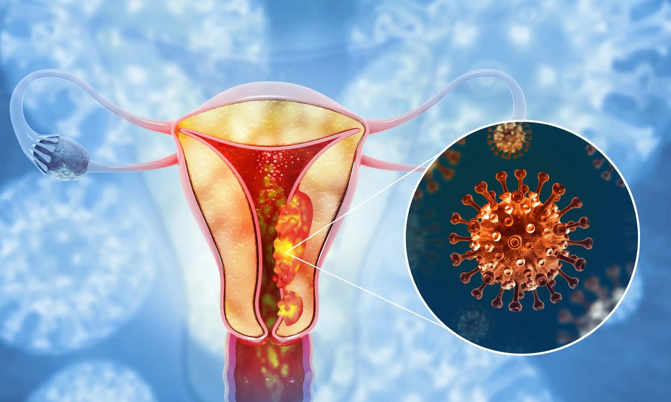 Spreading of Uterus or Womb Cancerous Cells