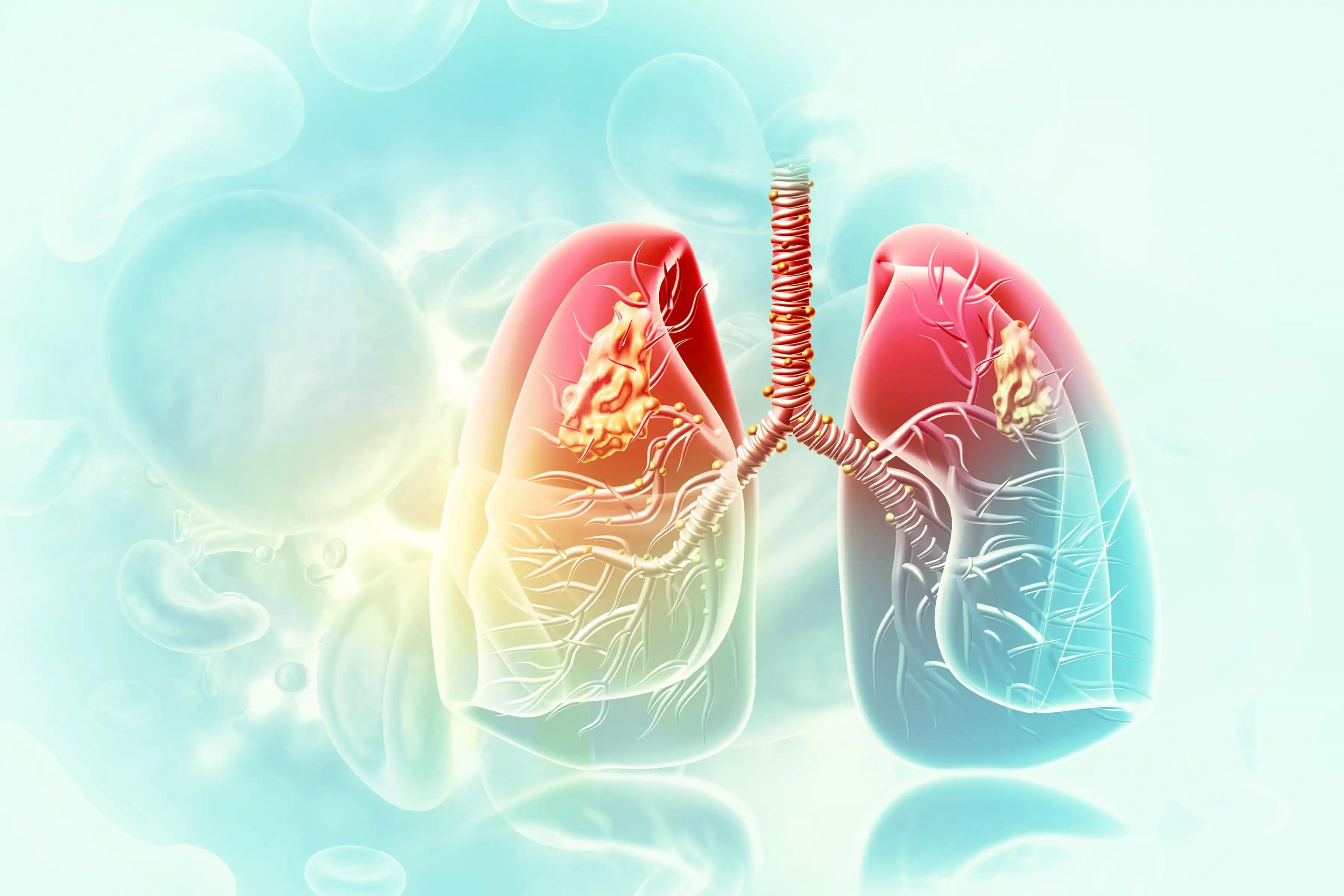 Thoracic Radiotherapy for Non-Small Cell Lung Cancer 