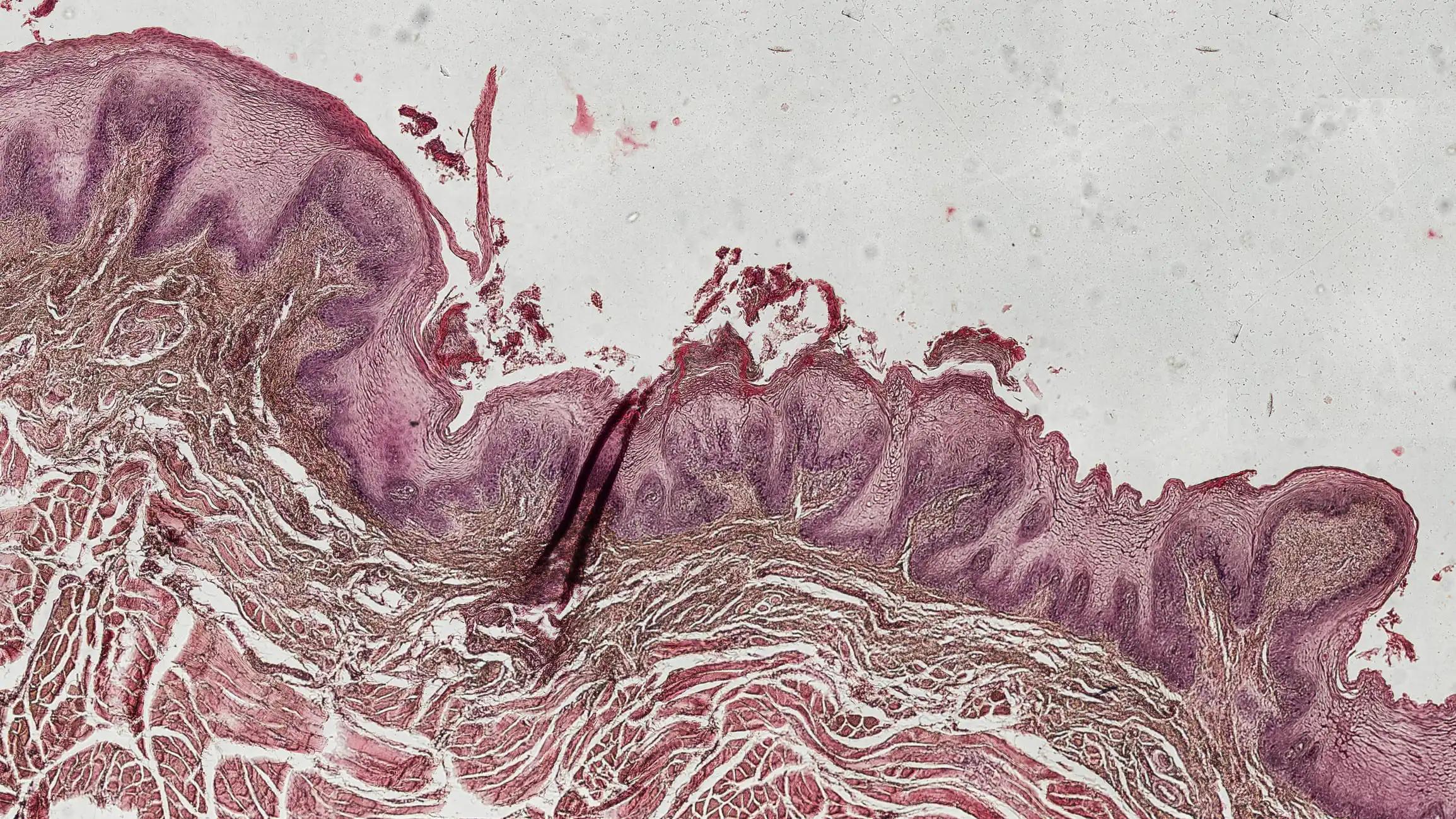 Tongue Squamous Carcinoma Cell