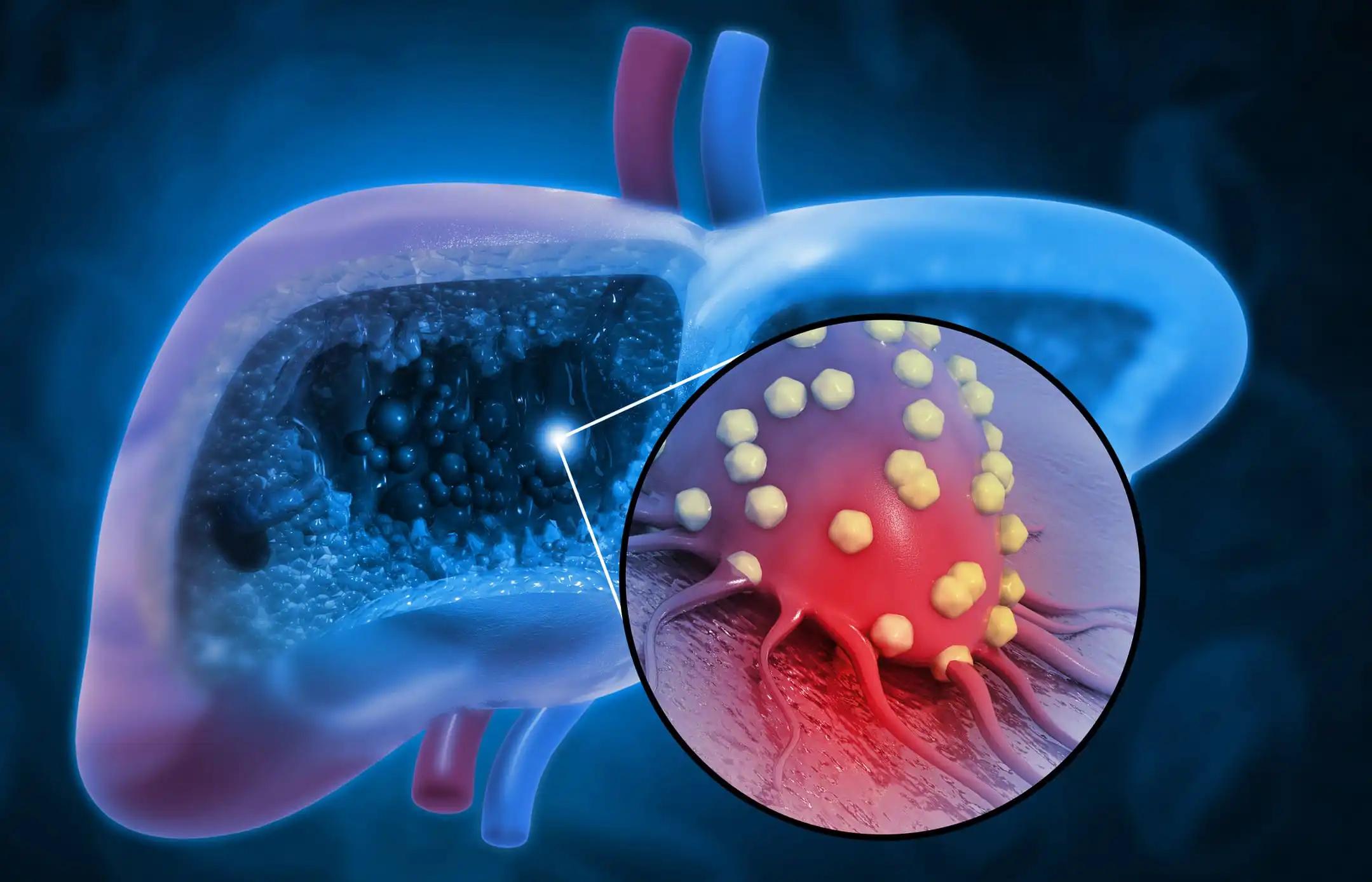 Tremelimumab & Durvalumab for Hepatocellular Carcinoma