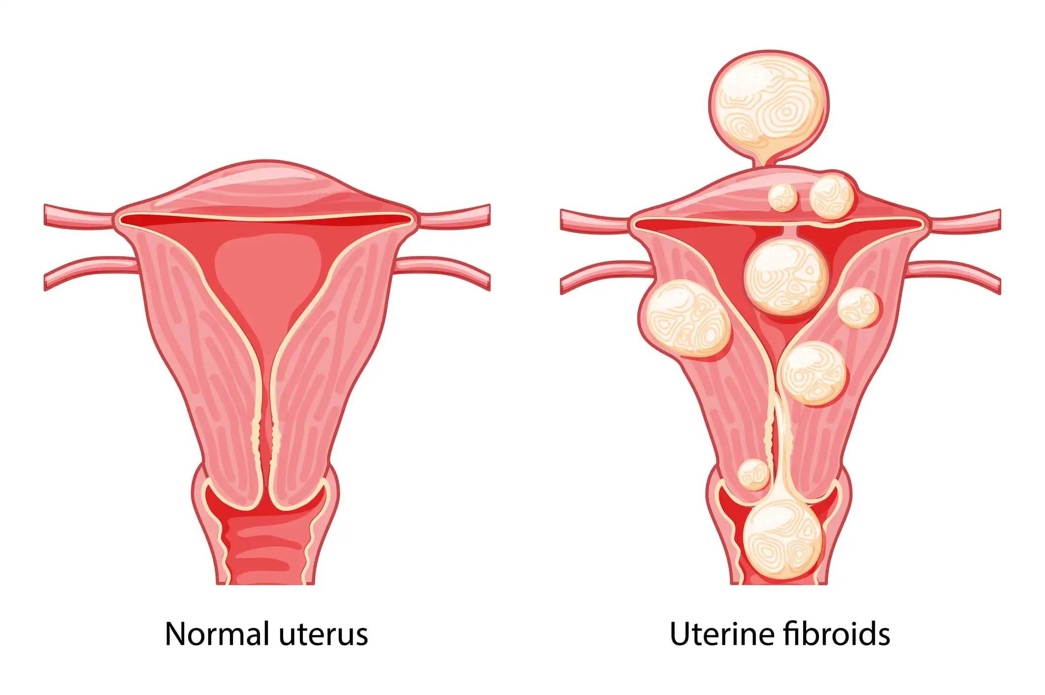 Uterine Fibroids Leiomyomas Reproductive System