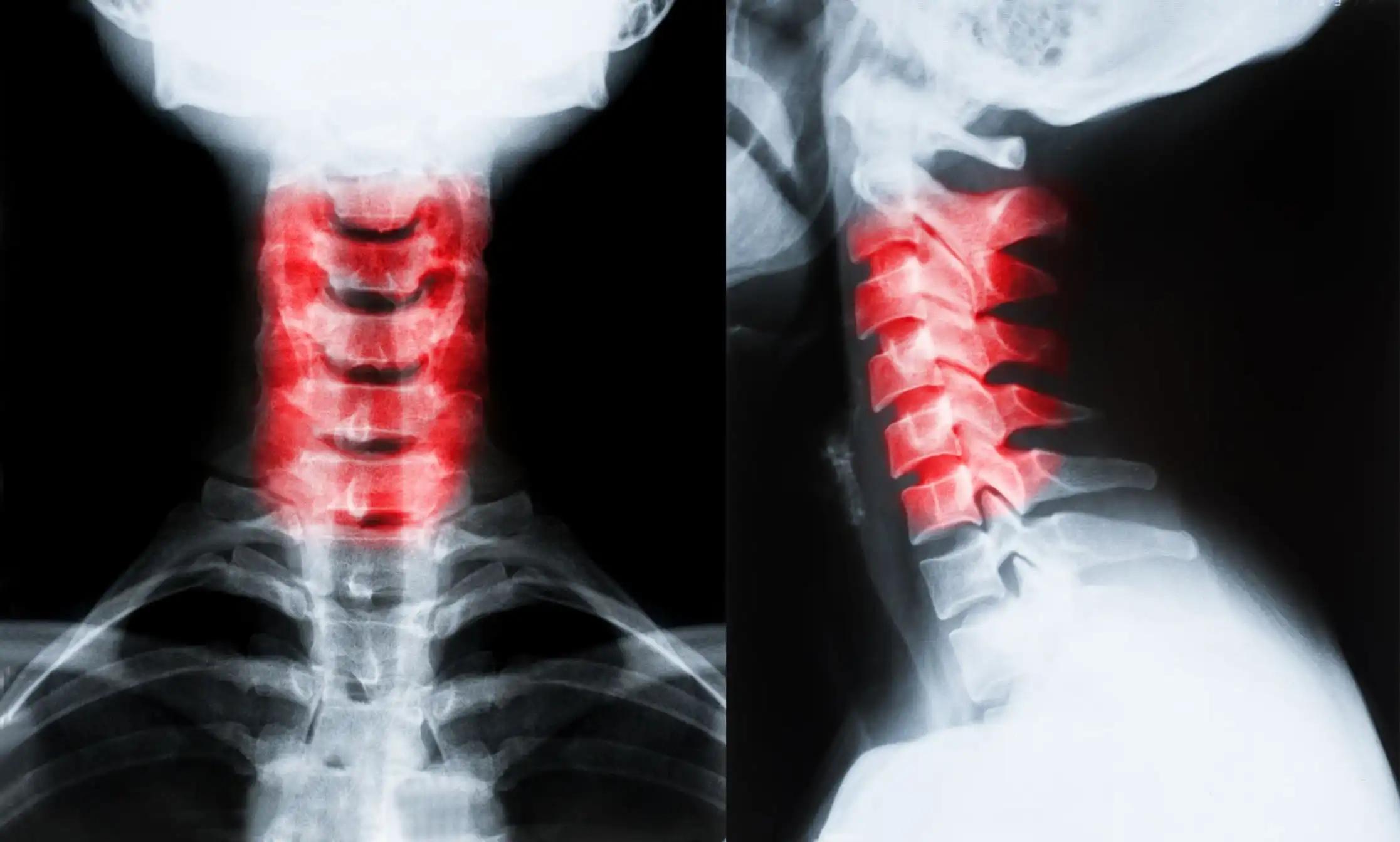 X-Ray of Neck Cervical Spine Swelling