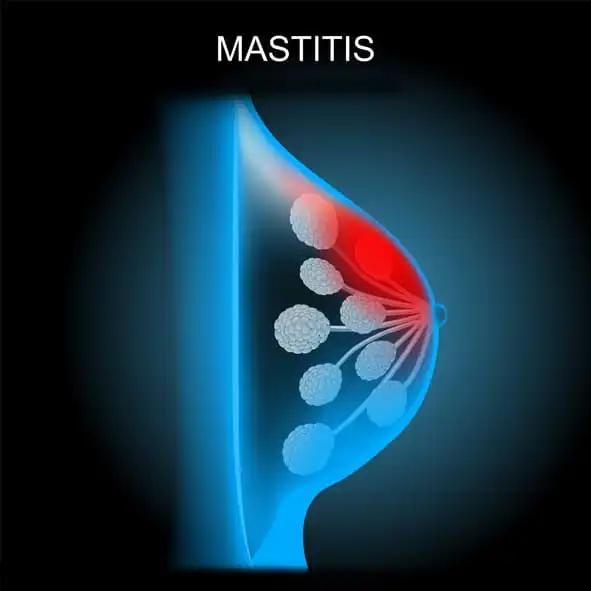 Mastitis X-ray Scanning of a Breast Vector