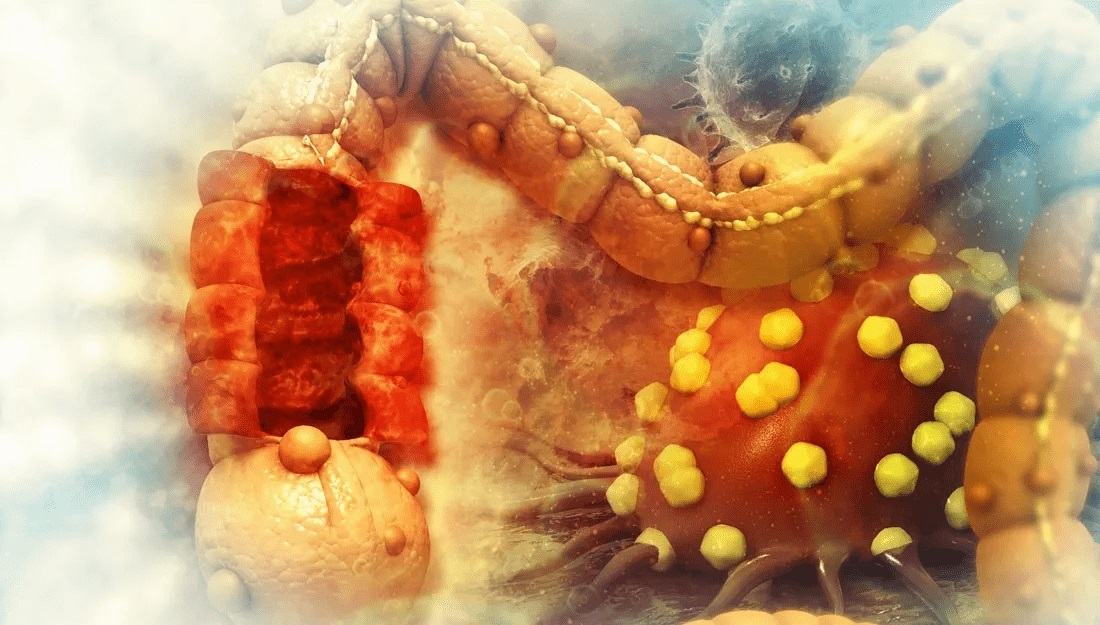 3d illustration of Colon Cancer Disease