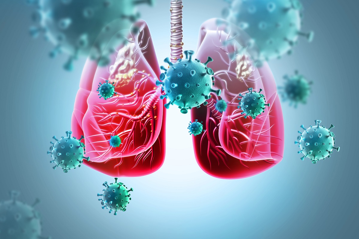 3d illustration of Bronchial Carcinoma