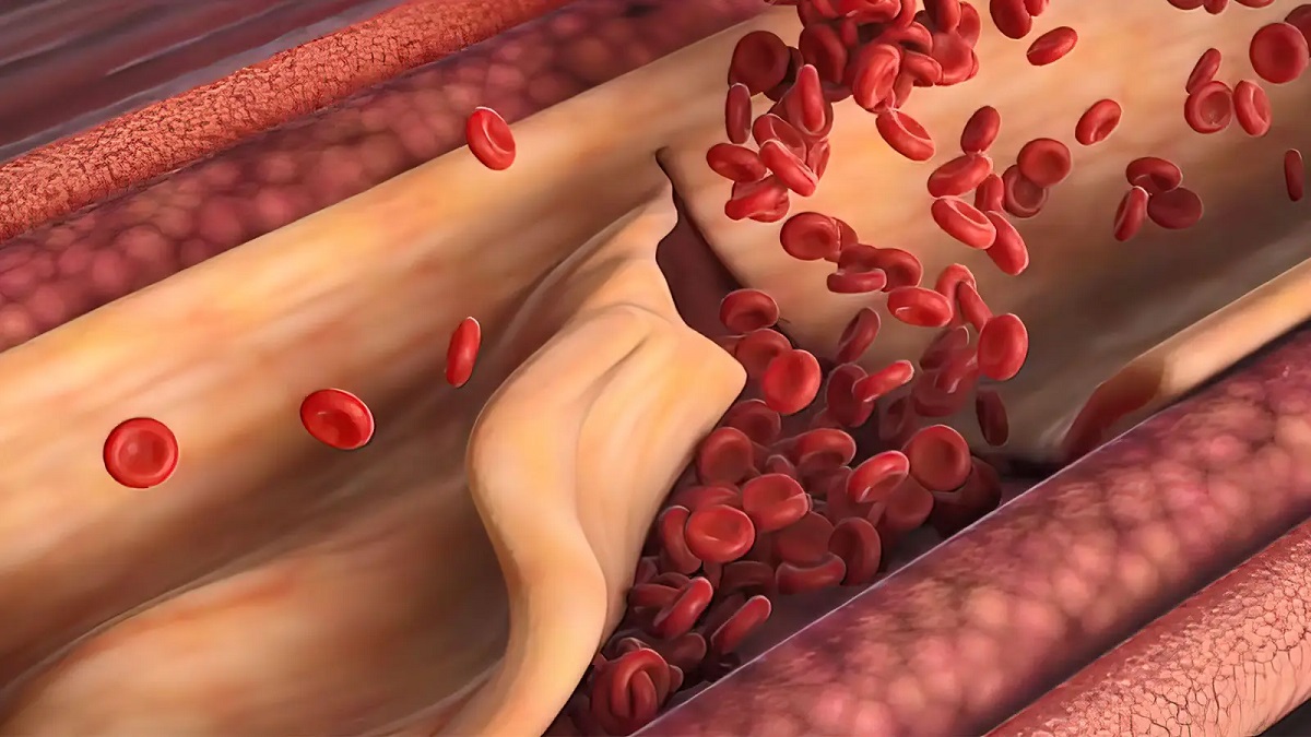 Helicobacter Pylori Becteria Infection in Stomach