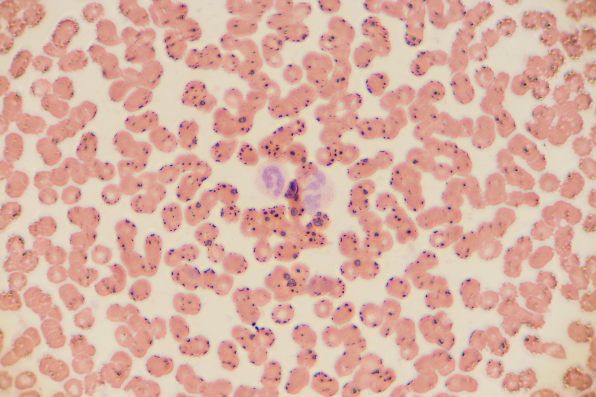 Microscopic View of Hepatocellular Carcinoma Cells