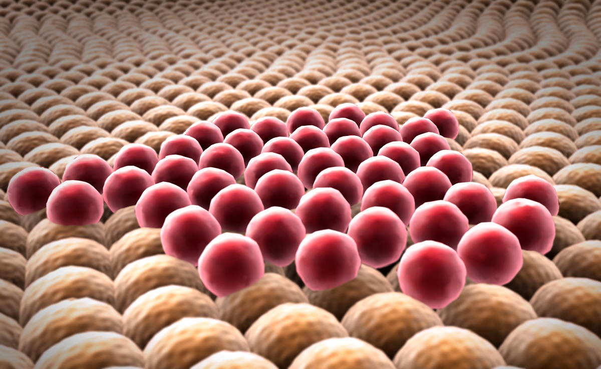 Liposarcoma Cancer Cells Under Microscope