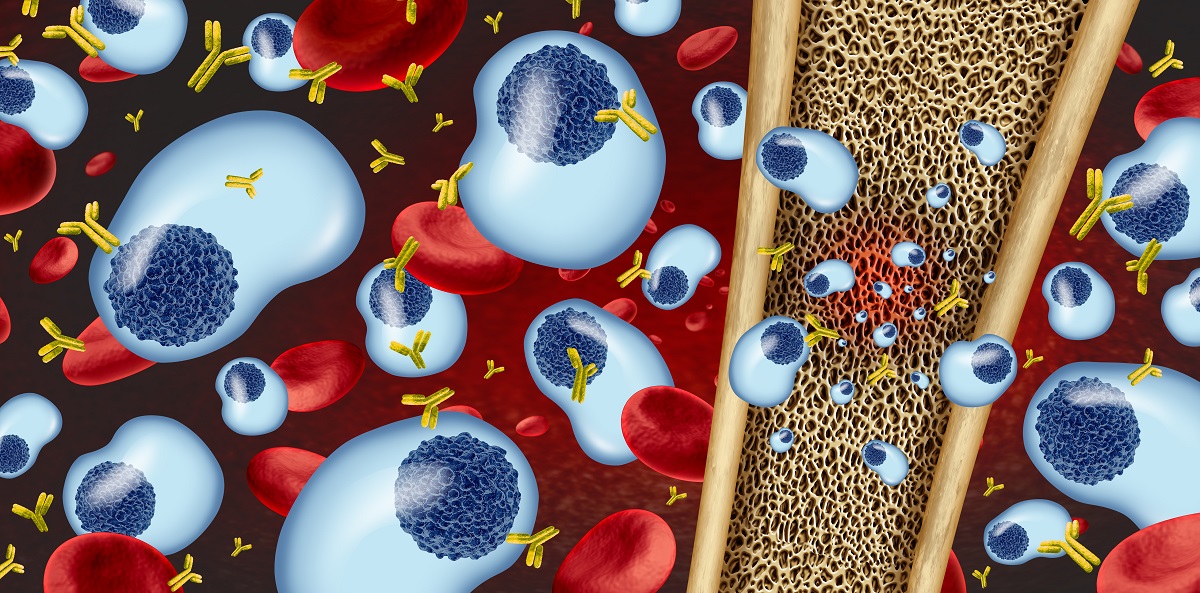 3D illustration of Multiple Myeloma as Cancerous Growth Inside the Bone Marrow