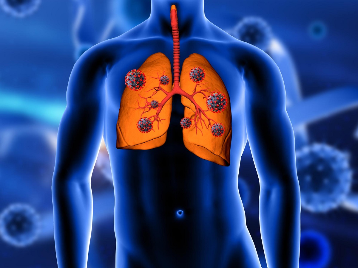 Non-Small Cell Lung Cancer Treatment