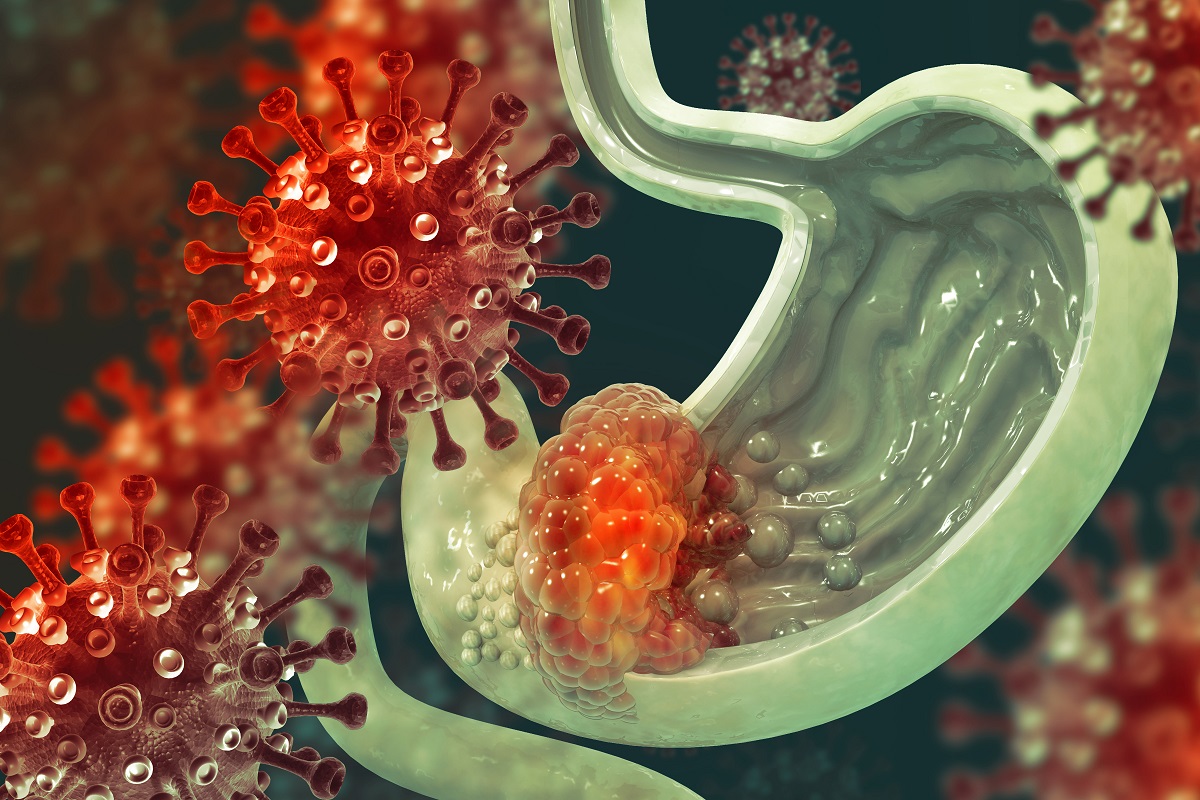 Cross Section of Stomach with Cancer Virus and Bacteria