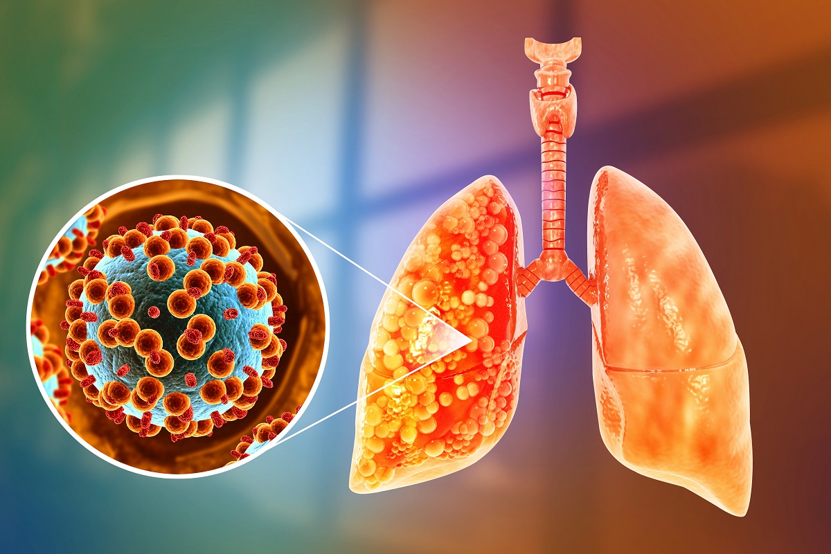 3d illustration Virus and Bacteria Infected the Lungs