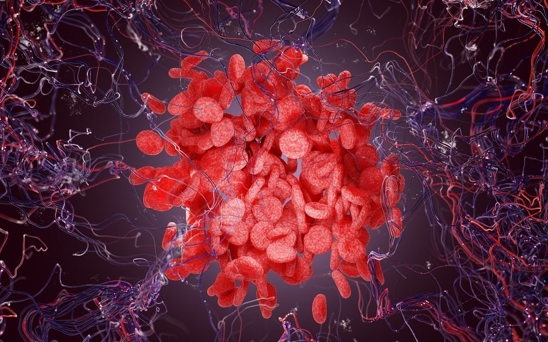 Ferroptosis and Its Impact on CML Diagnosis and Therapy